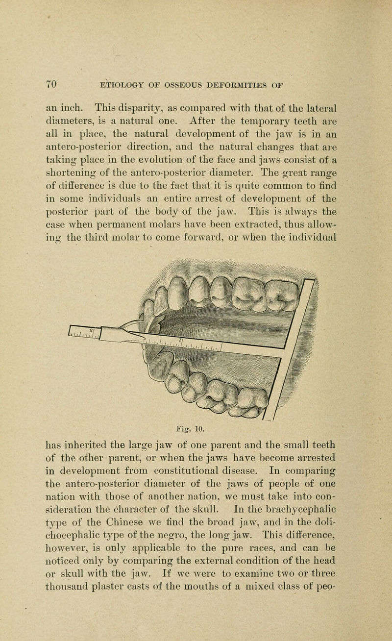 an inch. This disparity, as compared with that of the lateral diameters, is a natural one. After the temporary teeth are all in place, the natural development of the jaw is in an antero-posterior direction, and the natural changes that are taking place in the evolution of the face and jaws consist of a shortening of the antero-posterior diameter. The great range of difference is due to the fact that it is quite common to find in some individuals an entire arrest of development of the posterior part of the body of the jaw. This is always the case when permanent molars have been extracted, thus allow- ing the third molar to come forward, or when the individual Fig. 10. has inherited the large jaw of one parent and the small teeth of the other parent, or when the jaws have become arrested in development from constitutional disease. In comparing the antero-posterior diameter of the jaws of people of one nation with those of another nation, we must take into con- sideration the character of the skull. In the brachycephalic type of the Chinese we find the broad jaw, and in the doli- chocephalic type of the negro, the long jaw. This difference, however, is only applicable to the pure races, and can be noticed only by compai'ing the external condition of the head or skull with the jaw. If we were to examine two or three thousand plaster casts of the mouths of a mixed class of peo-