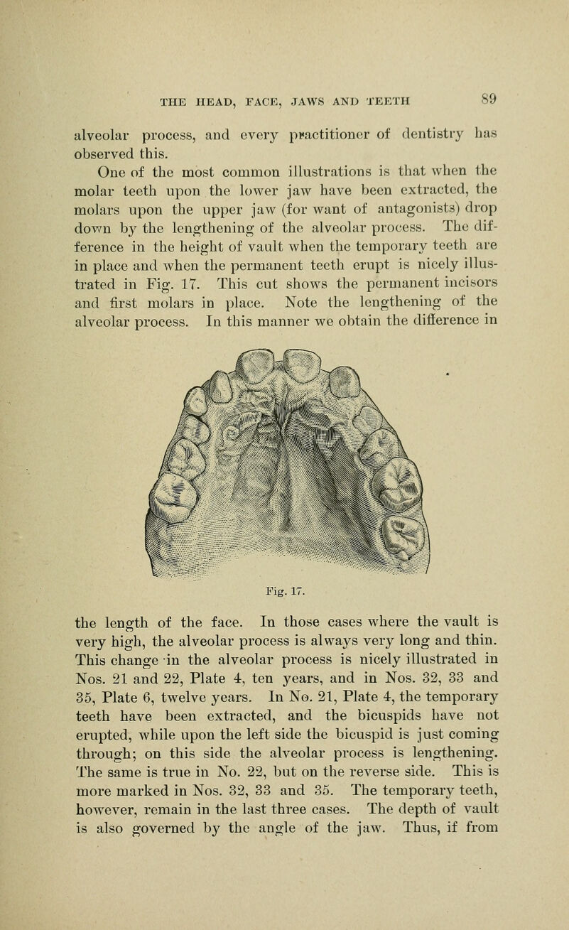 alveolar process, and every practitioner of dentistry has observed this. One of the most common illustrations is that when the molar teeth upon the lower jaw have been extracted, the molars upon the upper jaw (for want of antagonists) drop down by the lengthening of the alveolar process. The dif- ference in the height of vault when the temporary teeth are in place and when the permanent teeth erupt is nicely illus- trated in Fig. 17. This cut shows the permanent incisors and first molars in place. Note the lengthening of the alveolar process. In this manner we obtain the difierence in Pig. 17. the length of the face. In those cases where the vault is very high, the alveolar process is always very long and thin. This change in the alveolar process is nicely illustrated in Nos. 21 and 22, Plate 4, ten years, and in Nos. 32, 33 and 35, Plate 6, twelve years. In No. 21, Plate 4, the temporary teeth have been extracted, and the bicuspids have not erupted, while upon the left side the bicuspid is just coming through; on this side the alveolar process is lengthening. The same is true in No. 22, but on the reverse side. This is more marked in Nos. 32, 33 and 35. The temporary teeth, however, remain in the last three cases. The depth of vault is also governed by the angle of the jaw. Thus, if from