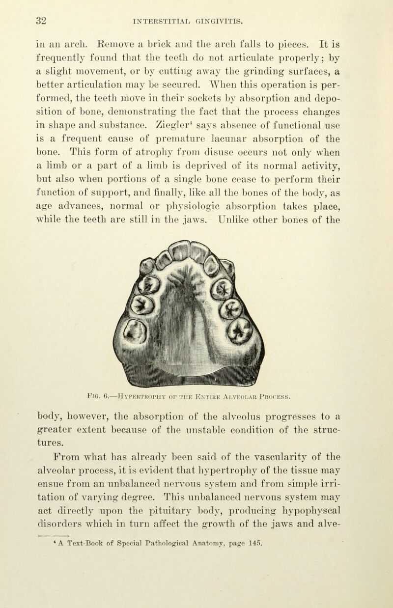 in an arch. Eemove a brick and the arch falls to pieces. It is frequently found that the teeth do not articulate properly; by a slight movement, or by cutting away the grinding surfaces, a better articulation may be secured. When this operation is per- formed, the teeth move in their sockets by absorption and depo- sition of bone, demonstrating the fact that the process changes in shape and substance. Ziegler* says absence of functional use is a frequent cause of premature lacunar absorption of the bone. This form of atrophy from disuse occurs not only when a limb or a part of a limb is deprived of its normal activity, but also when portions of a single bone cease to perform their function of support, and finally, like all the bones of the body, as age advances, normal or physiologic absorption takes place, while the teeth are still in the jaws. Unlike other bones of the Fjg. 6.—Hypertrophy of the Entire Alveolar Process. body, however, the absorption of the alveolus progresses to a greater extent because of the unstable condition of the struc- tures. From what has already been said of the vascularity of the alveolar process, it is evident that hypertrophy of the tissue may ensue from an unbalanced nervous system and from simple irri- tation of varying degree. This unbalanced nervous system may act directly upon the pituitary body, producing hypophyseal disorders which in turn aifect the growth of the jaws and alve- * A Text-Book of Special Pathological Anatomy, page 145.