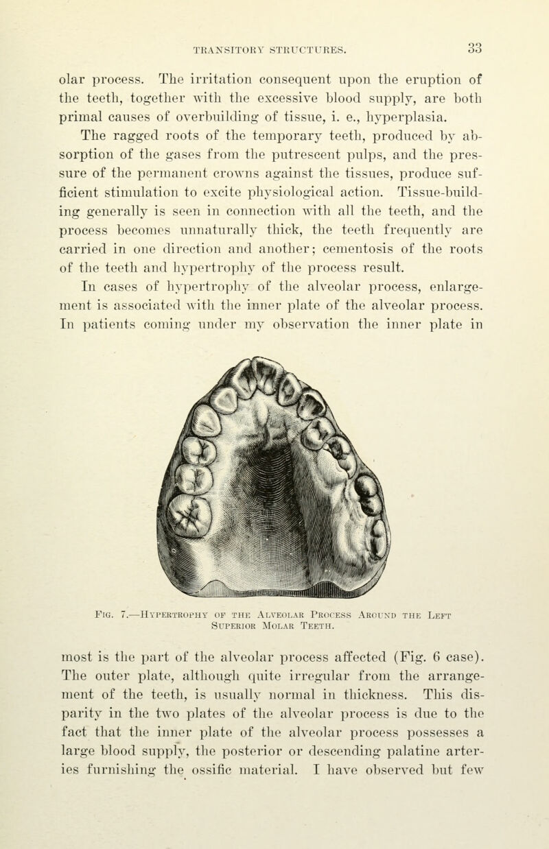 olar process. The irritation consequent upon the eruption of the teeth, together mth the excessive blood supply, are both primal causes of overbuilding of tissue, i. e., hyperplasia. The ragged roots of the temporary teeth, produced by ab- sorption of the gases from the putrescent pulps, and the pres- sure of the permanent crowns against the tissues, produce suf- ficient stimulation to excite physiological action. Tissue-build- ing generally is seen in connection with all the teeth, and the process becomes unnaturally thick, the teeth frequently are carried in one direction and another; cementosis of the roots of the teeth and hypertrophy of the process result. In cases of hypertrophy of the alveolar process, enlarge- ment is associated with the inner plate of the alveolar process. In patients coming under my observation the inner plate in Fig. 7.—Hypertrophy of the Alveolar 1'rocess Around the Left Superior Molar Teeth. most is the part of the alveolar process affected (Fig. 6 case). The outer plate, although quite irregular from the arrange- ment of the teeth, is usually normal in thickness. This dis- parity in the two plates of the alveolar process is due to the fact that the inner plate of the alveolar process possesses a large blood supply, the posterior or descending palatine arter- ies furnishing the ossific material. I have observed but few