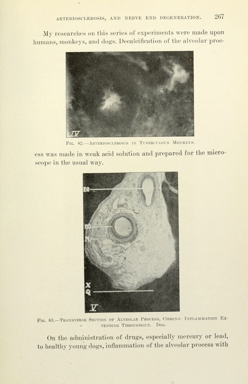 My researches on this series of experiments were made upon humans, monkeys, and dogs. Decalcification of the alveohir proc- FiG. 82.—Arteriosclerosis in Tuberculous Monkeys. ess was made in weak acid solution and prepared for the micro- scope in the usual way. Fig. 83.—Transverse Section of Alveolar Process, Chronic Inflammation Ex- tending Throughout. Dog. On the administration of drugs, especially mercury or lead, to healthy young dogs, inflammation of the alveolar process with