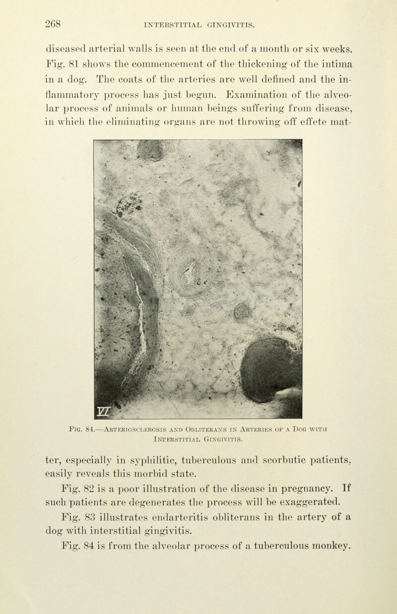 diseased arterial walls is seen at the end of a month or six weeks. Fig. 81 shows the commencement of the thickening of the intima in a dog. The coats of the arteries are well defined and the in- flammatory process has jnst begun. Examination of the alveo- lar process of animals or human beings suffering from disease, in which the eliminating organs are not throwing off effete mat- FiG. 84.—Arteriosclerosis and Obliterans in Arteries of a Dog with Interstitial Gingivitis. ter, especially in syphilitic, tuberculous and scorbutic patients, easily reveals this morbid state. Fig. 82 is a poor illustration of the disease in pregnancy. If such patients are degenerates the process will be exaggerated. Fig. 83 illustrates endarteritis obliterans in the artery of a dog with interstitial gingivitis. Fig. 84 is from the alveolar process of a tuberculous monkey.