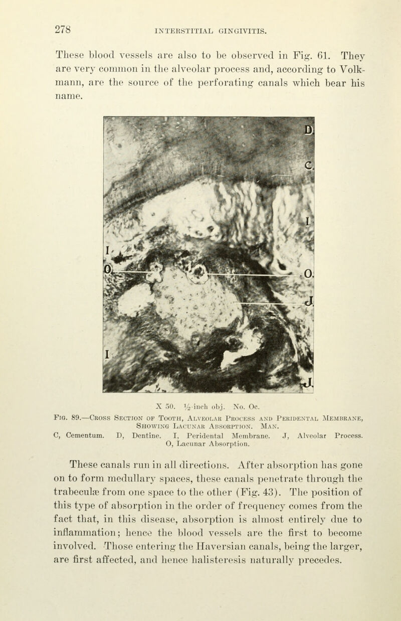 These blood vessels are also to be observed in Fig. 61. They are very common in the alveolar process and, according to Volk- mann, are the source of the perforating canals which bear his name. X 50. i/i;-iiich obj. No. Oc. Fig. 89.—Cross Section of Tooth, Alveolar Process and Peridental Membrane, C, Cementum. D. Showing Lacunar Absorption. Man. Dentine. I, Peridental Membrane. J, Alveolar Process. O, Lacunar Absorption. These canals run in all directions. After absorption has gone on to form medullary spaces, these canals penetrate through the trabeculae from one space to the other (Fig. 43). The position of this type of absorption in the order of frequency comes from the fact that, in this disease, absorption is almost entirely due to inflammation; hence the blood vessels are the first to become involved. Those entering the Haversian canals, being the larger, are first affected, and hence halisteresis naturally precedes.