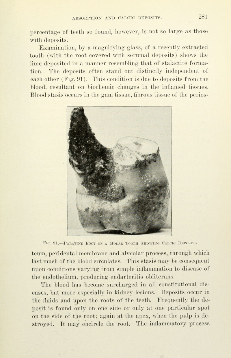 percentage of teeth so found, however, is not so large as those with deposits. Examination, by a magnifying glass, of a recently extracted tooth (with the root covered with sernmal deposits) shows the lime deposited in a manner resembling that of stalactite forma- tion. The deposits often stand out distinctly independent of each other (Fig. 91). This condition is due to deposits from the blood, resultant on biochemic changes in the inflamed tissues. Blood stasis occurs in the gum tissue, fibrous tissue of the perios- FiG. 91.—Palatine Eoot of a Molar Tooth Showing Calcic Deposits. teum, peridental membrane and alveolar process, through which last much of the blood circulates. This stasis may be consequent upon conditions varying from simple inflammation to disease of the endothelium, producing endarteritis obliterans. The blood has become surcharged in all constitutional dis- eases, but more especially in kidney lesions. Deposits occur in the fluids and upon the roots of the teeth. Frequently the de- posit is found only on one side or only at one particular spot on the side of the root; again at the apex, when the pulp is de- stroyed. It may encircle the root. The inflammatory process