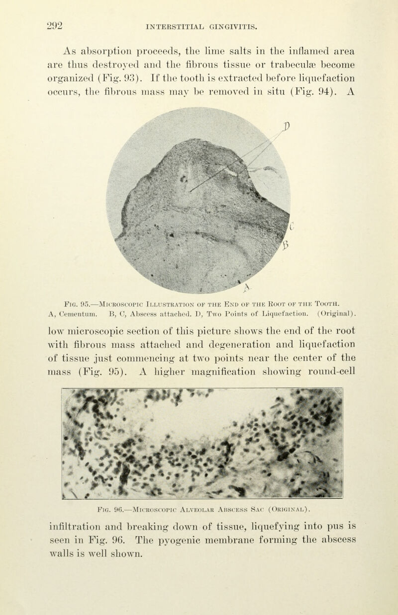 As absorption proceeds, the lime salts in the inflamed area are thus destroy ed and the fibrous tissue or trabecule become organized (Fig. 93). If the tooth is extracted before liquefaction occurs, the fibrous mass may be removed in situ (Fig. 94). A .M Fig. 95.—Microscopic Illustration of the End of the Root of the Tooth. A, Cemeiitum. B, C, Abscess attached. D, Two Points of Liquefaction. (Original). low microscopic section of this picture shows the end of the root with fibrous mass attached and degeneration and liquefaction of tissue just commencing at two points near the center of the mass (Fig. 95). A higher magnification showing round-cell Tv-.^ r ^K%kt^ Fig. 96.—Microscopic Alveolar Ap,sce.s.s Sac (Original). infiltration and breaking down of tissue, liquefying into pus is seen in Fig. 96. The pyogenic membrane forming the abscess walls is well shown.