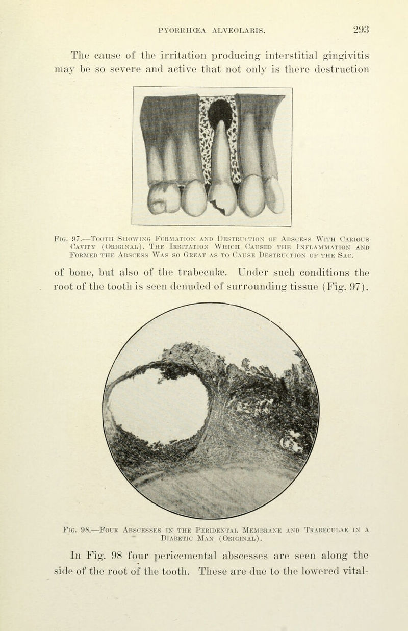 The cause of the irritation producing interstitial gingivitis may be so severe and active that not only is there destruction Fig. 97.—Tooth Showing Formation and Destruction of Abscess With Carious Cavity (Original). The Irritation Which Caused the Inflammation and Formed the Abscess Was so Great as to Cause Destruction of the Sac. of bone, but also of the trabeculae. Under such conditions the root of the tooth is seen denuded of surrounding tissue (Fig. 97). Fig. 98.—Four Abscesses in the Peridental Membrane and Trabeculae in a Diabetic Man (Original). In Fig. 9(S four pericemental abscesses are seen along the side of the root of the tooth. These are due to the lowered vital-