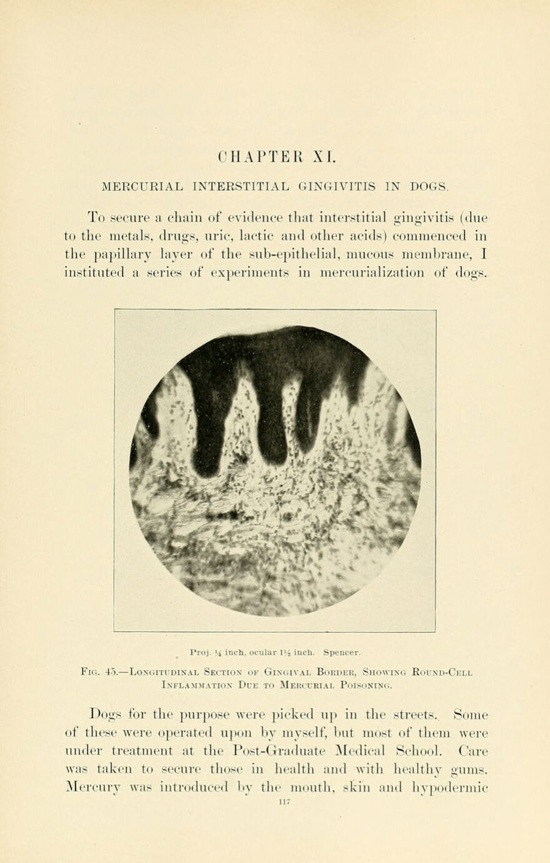 MERCURIAL INTERSTITIAL GINC4IVITIS IN DOGS. To secure a chain of evidence that interstitial gingivitis (due to the metals, drugs, uric, lactic and other acids) commenced in the papillary layer of the sub-ej^ithelial, mucous membrane, I instituted a series of experiments in mercurialization of dogs. Proj. 14 inch, ocular lii inch. Spencer. Fig. 4.5.—Longitudinal Section op Gingival Boedke, Showing Eound-Cell Inflajimation Due to Mercurial Poisoning. Dogs for the purpose were picked up in the streets. Some of these were operated upon by myself, but most of them were under treatment at the Post-Graduate Medical School. Care Avas taken to secure those in health and with healthy gums. Mercury was introduced l)y the mouth, skin and liypodermic