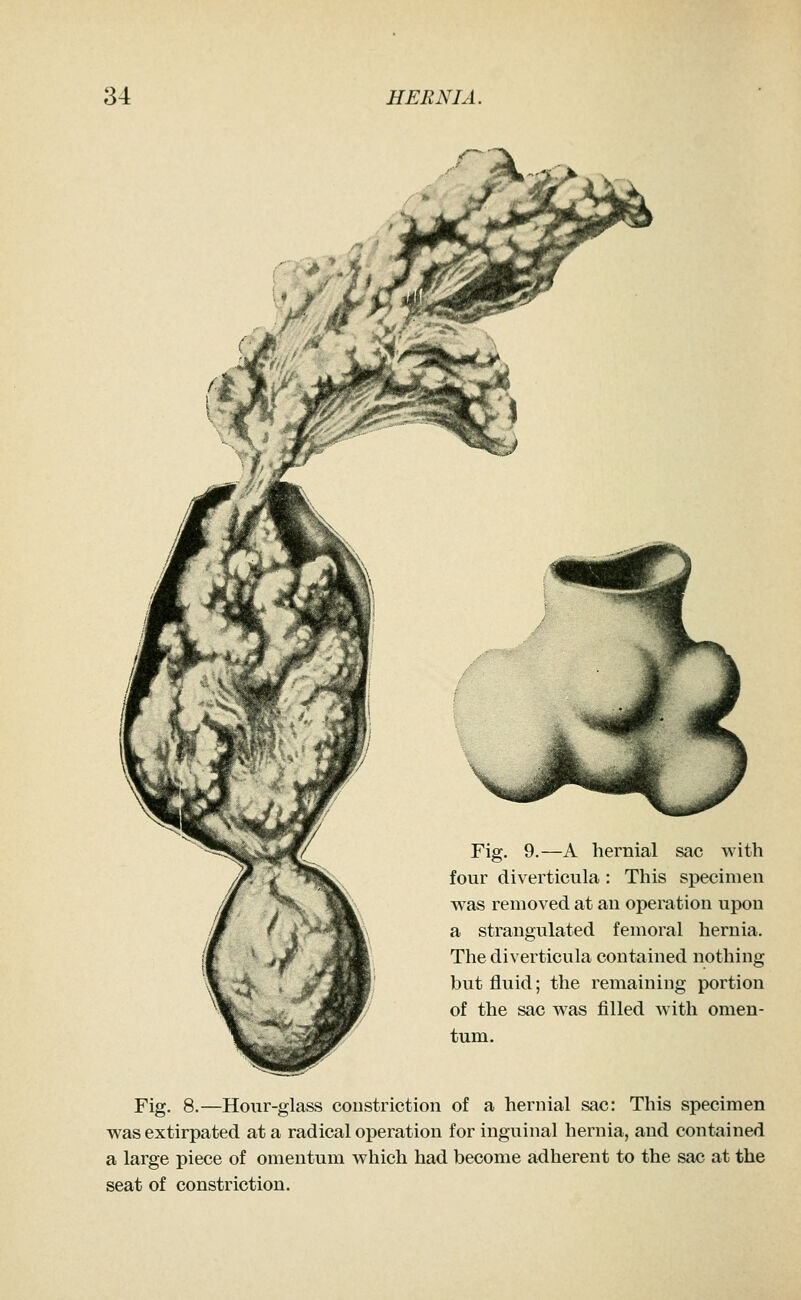 Fig. 9.—A hernial sac with four diverticula : This specimen was removed at an operation upon a strangulated femoral hernia. The diverticula contained nothing but fluid; the remaining portion of the sac was filled with omen- tum. Fig. 8.—Hour-glass constriction of a hernial sac: This specimen was extirpated at a radical operation for inguinal hernia, and contained a large piece of omentum which had become adherent to the sac at the seat of constriction.