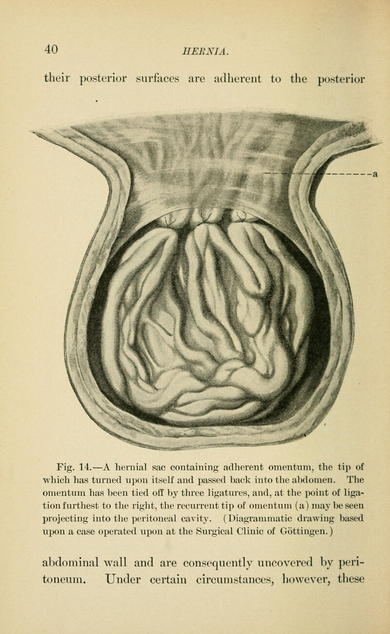 their posterior surfaces are adherent to the posterior Fig. 14.—A hernial sac containing adherent omentnm, the tip of which has turned upon itself and passed back into the abdomen. The omentum has been tied off by three ligatures, and, at the point of liga- tion furthest to the right, the recurrent tip of omentum (a) may be seen projecting into the peritoneal cavity. (Diagrammatic drawing based upon a case operated upon at the Surgical Clinic of Gottingen.) abdominal wall and are consequently uncovered by peri- toneum. Under certain circumstances, however, these