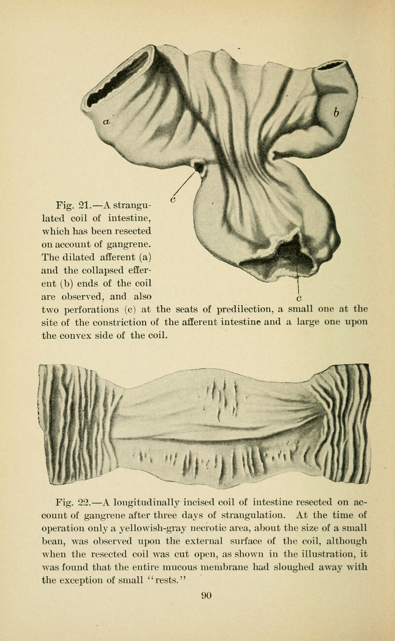 Fig, 21.—A strangu- lated coil of intestine, which has been resected on account of gangrene. The dilated afferent (a) and the collapsed effer- ent (b) ends of the coil are observed, and also C two perforations (c) at the seats of predilection, a small one at the site of the constriction of the afferent intestine and a large one upon the convex side of the coil. <~<»*<mw*»»«r<Kt*'^*?S^^ ■»•. Fig. 22.—A longitudinally incised coil of intestine resected on ac- count of gangrene after three days of strangulation. At the time of operation only a yellowish-gray necrotic area, about the size of a small bean, was observed upon the external surface of the coil, although when the resected coil was cut open, as shown in the illustration, it was found that the entire mucous membrane hud sloughed away with the exception of small rests.