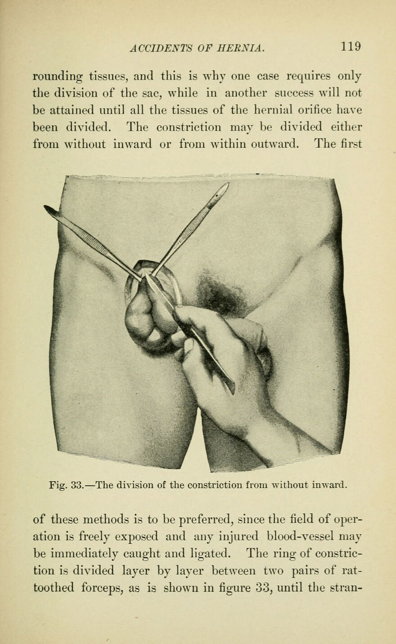 rounding tissues, and this is why one case requires only the division of the sac, while in another success will not be attained until all the tissues of the hernial orifice have been divided. The constriction may be divided either from without inward or from within outward. The first Fig. 33.—The division of the constriction from without inward. of these methods is to be preferred, since the field of oper- ation is freely exposed and any injured blood-vessel may be immediately caught and ligated. The ring of constric- tion is divided layer by layer between two pairs of rat- toothed forceps, as is shown in figure 33, until the stran-