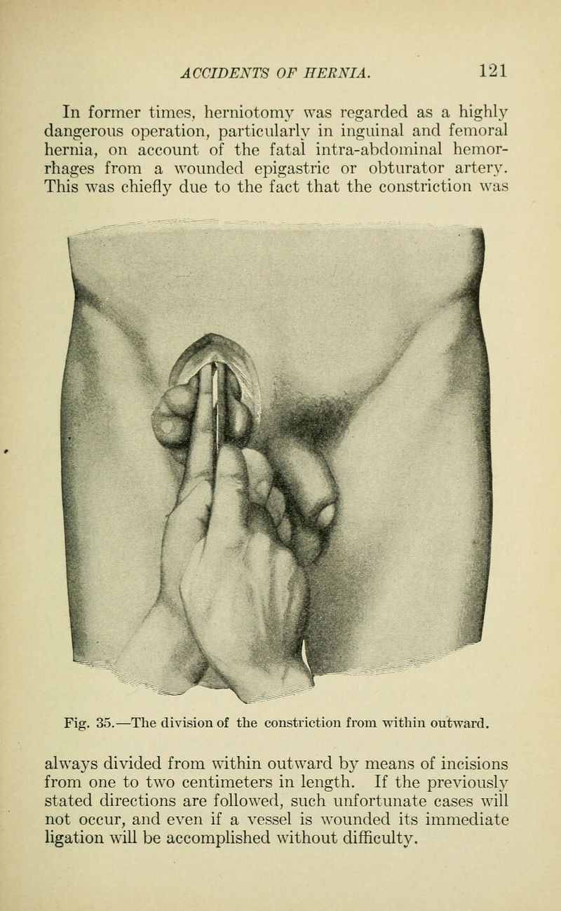 In former times, herniotomy was regarded as a highly dangerous operation, particularly in inguinal and femoral hernia, on account of the fatal intra-abdominal hemor- rhages from a wounded epigastric or obturator artery. This was chiefly due to the fact that the constriction was Fig. 35.—The division of the constriction from within outward. always divided from mthin outward by means of incisions from one to two centimeters in length. If the previously stated directions are followed, such unfortunate cases will not occur, and even if a vessel is wounded its immediate ligation will be accomplished without difficulty.