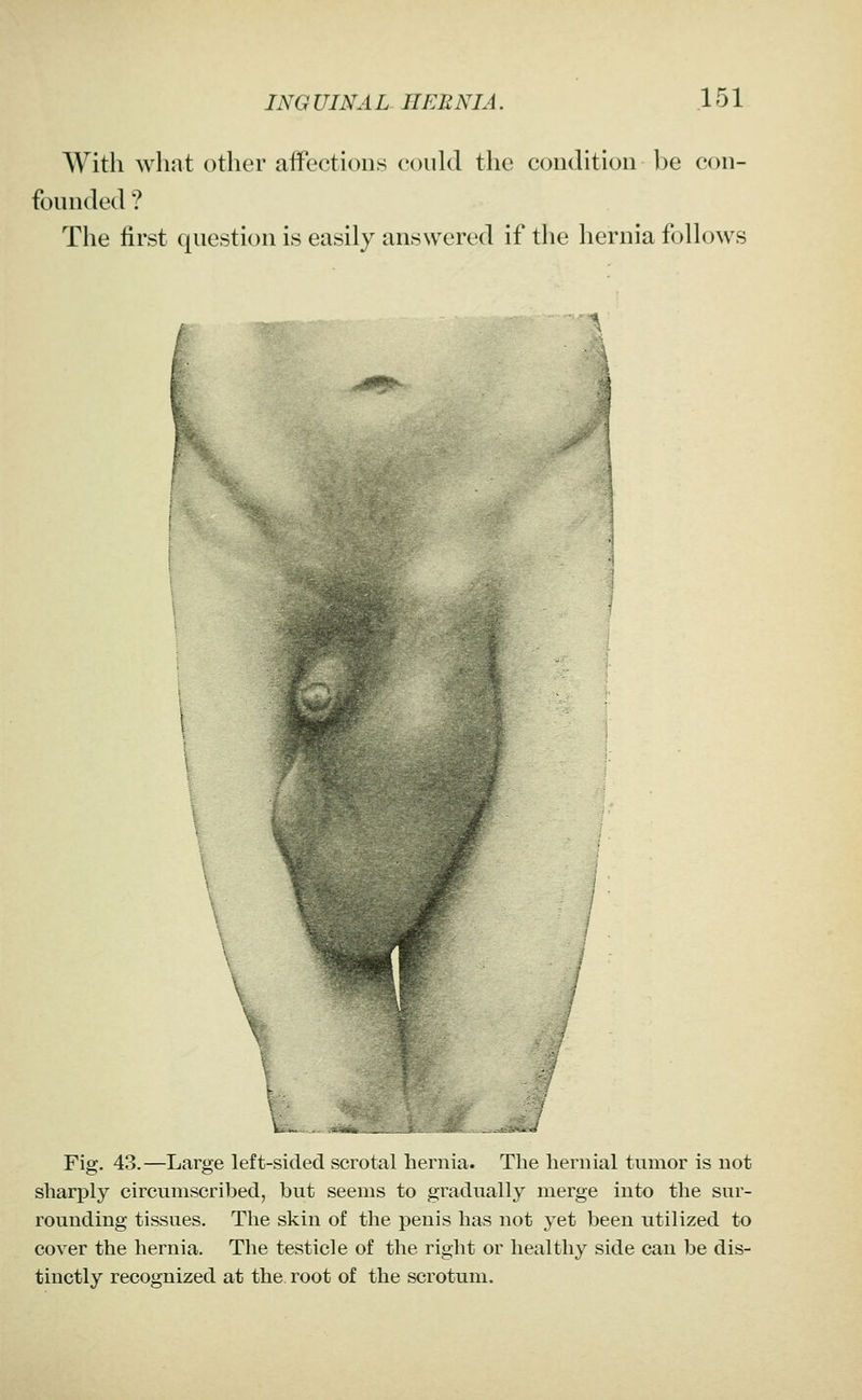 With what other affections eoiild the condition be con- founded ? The first question is easily answered if the hernia follows :^ps?5; \ Fig. 43.—Large left-sided scrotal hernia. The hernial tumor is not sharply circumscribed, but seems to gradually merge into the sur- rounding tissues. Tlie skin of the penis has not yet been utilized to cover the hernia. The testicle of the right or healthy side can be dis- tinctly recognized at the root of the scrotum.