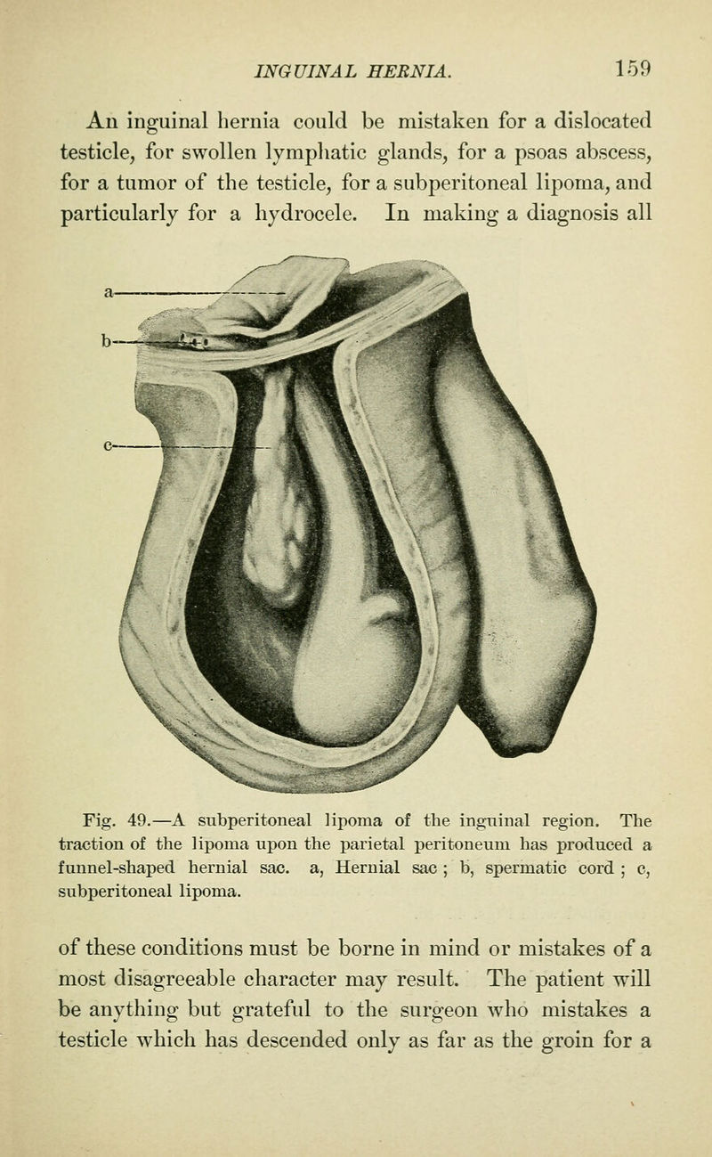 An inguinal hernia could be mistaken for a dislocated testicle, for swollen lymphatic glands, for a psoas abscess, for a tumor of the testicle, for a subperitoneal lipoma, and particularly for a hydrocele. In making a diagnosis all Fig. 49.—A subperitoneal lipoma of the inguinal region. The traction of the lipoma upon the parietal peritoneum has produced a funnel-shaped hernial sac. a, Hernial sac ; b, spermatic cord ; c, subperitoneal lipoma. of these conditions must be borne in mind or mistakes of a most disagreeable character may result. The patient will be anything but grateful to the surgeon who mistakes a testicle which has descended only as far as the groin for a