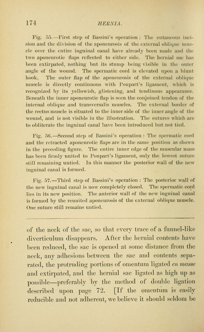 Fig. 55.—First step of Bassini's oi)erati()ii : The cutaneous inci- sion and the division of tlie aponeurosis of the external ol)li(]ue mus- cle over the entire inguinal canal have already lieen made and tlic two aponeurotic flaps reflected to either side. The hernial sac has been extirpated, nothing but its stiimp being visible in tlie outer angle of the wound. The spermatic cord is elevated upon a l)lunt hook. The outer flap of the aponeurosis of the external oljlique muscle is directly continuous with Poupart's ligament, which is recognized by its yellowash, glistening, and tendinous appearance. Beneath the inner aponeurotic flap is seen the conjoined tendon of the internal oblique and transversalis muscles. The external border of the rectus muscle is situated to the inner side of the inner angle of tlie wound, and is not visible in the illustration. The sutures which are to obliterate the inguinal canal have been introduced but not tied. Fig. 56.—Second step of Bassini's operation : The spermatic cord and the retracted aponeurotic flaps are in the same position as shown in the preceding figure. The entire inner edge of the muscular mass has been firmly united to Poupart's ligament, only the lowest suture still remaining untied. In this manner the posterior wall of the new inguinal canal is formed. Fig. 57.—Third step of Bassini's operation : The posterior wall of the new inguinal canal is now completely closed. The spermatic cord lies in its new position. The anterior wall of the new inguinal canal is formed by the reunited aponeurosis of the external oblique muscle. One suture still remains untied. of the neck of the sac, so that every trace of a funnel-like diverticulum disappears. After the hernial contents have been reduced, the sac is opened at some distance from the neck, any adhesions between the sac and contents sepa- rated, the protruding portions of omentum ligated en masse and extirpated, and the hernial sac ligated as high up as possible—preferably by the method of double ligation described upon page 72. [If the omentum is easily reducible and not adherent, we believe it should seldom be