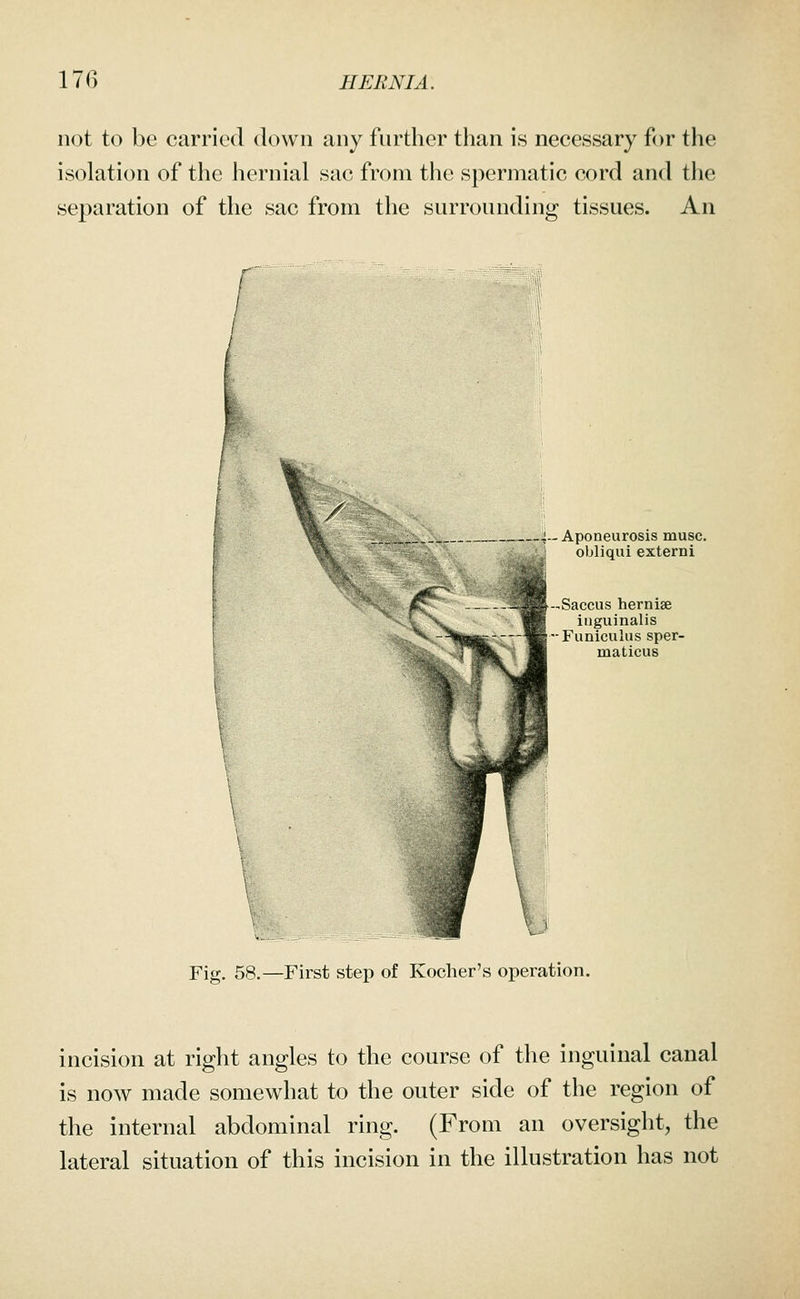 not to be carried down any further than is necessary for the isolation of the hernial sac from the spermatic cord and the separation of the sac from the surrounding tissues. An • Aponeurosis muse, obliqui externi -Saccus hernise inguinalis ■Funiculus sper- maticus Fig. 58.—First step of Kocher's operation. incision at right angles to the course of the inguinal canal is now made somewhat to the outer side of the region of the internal abdominal ring. (From an oversight, the lateral situation of this incision in the illustration has not