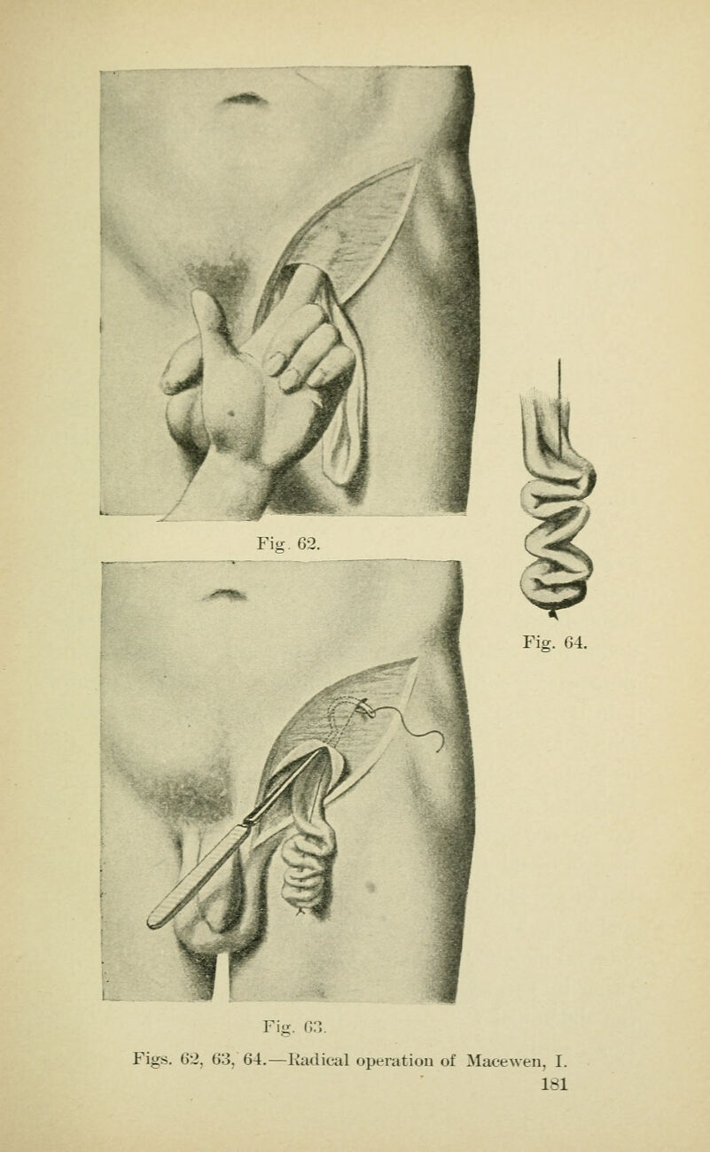 I Fig. 63. Figs. 62, 63, 64.—Kadical operation of Macewen, I.