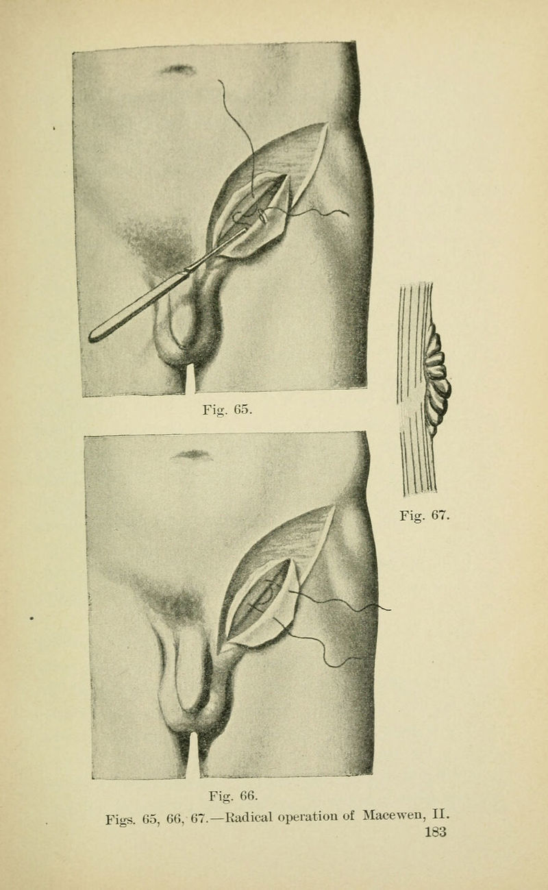 Fig. 66. Figs 65, 66, 67.—Radical operatiou of Macewen, II.