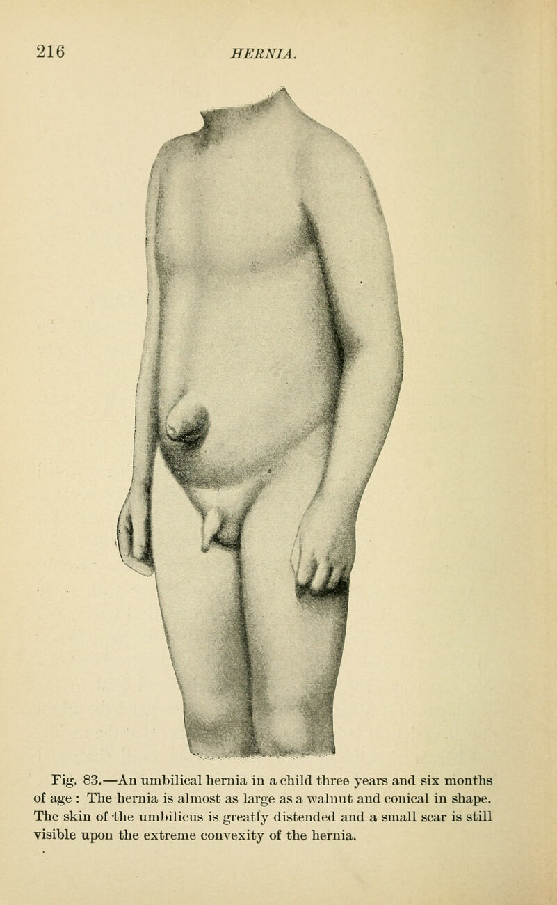 Fig. 83.—An umbilical hernia in a child three years and six months of age : The hernia is almost as large as a walnut and conical in shape. The skin of the umbilicus is greatly distended and a small scar is still visible upon the extreme convexity of the hernia.