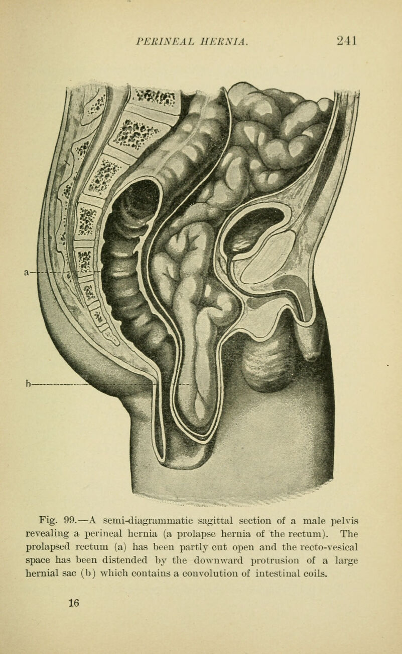 a-i- b Fig. 99.—A semi-diagrammatic sagittal section of a male pelvis revealing a perineal hernia (a prolapse hernia of the rectum). The prolapsed rectum (a) has been partl}^ cut open and the recto-vesical space has been distended by the downward protrusion of a large hernial sac (b) which contains a convolution of intestinal coils. 16