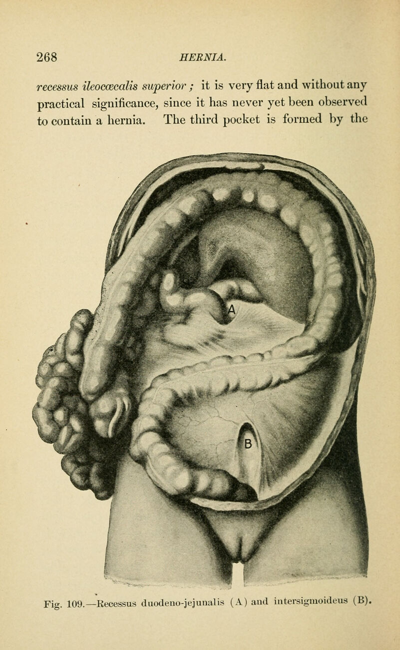 recessus ileoccecalis swperior ; it is very flat and without any- practical significance, since it has never yet been observed to contain a hernia. The third pocket is formed by the Fig. 109.—Recessus duodeno-jejunalis (A) and intersigmoideus (B).