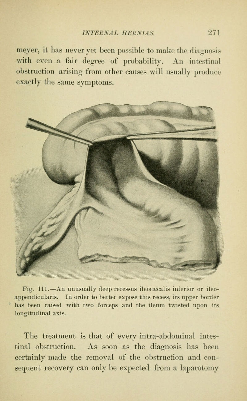 meyer, it has never yet been jx)ssiblc to make the diagnosis with even a fair degree of probability. An intestinal obstrnction arising from other causes will usually produce exactly the same symptoms. Fig. 111.—An unusually deep recessus ileocsecalis inferior or ileo- appendicularis. In order to better expose this recess, its upper border has been raised with two forceps and the ileum twisted upon its longitudinal axis. The treatment is that of every intra-abdominal intes- tinal obstruction. As soon as the diagnosis has been certainly made the removal of tlie obstruction and con- sequent recovery can only be expected from a laparotomy