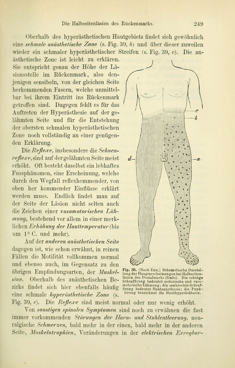 Oberhalb des h}i)erästhetischen Hautgebiets findet sich gewöhnlich eine schmale anusthetische Zone (s. Fig. 39, b) und über dieser zuweilen wieder ein schmaler hjperästhetischer Streifen (s. Fig. 39, c). Die an- ästhetische Zone ist leicht zu erklären. Sie entspricht genau der Höhe der Lä- sionsstelle im Rückenmark, also den- jenigen sensibeln, von der gleichen Seite herkommenden Fasern, welche unmittel- bar bei ihrem Eintritt ins Rückenmark getroffen sind. Dagegen fehlt es für das Auftreten der Hyperästhesie auf der ge- lähmten Seite und für die Entstehung der obersten schmalen hj^erästhetischen Zone noch vollständig an einer genügen- den Erklärung. Die Reflexe, insbesondere die Sehnen- reßexe, sind auf der gelähmten Seite meist erhöht. Oft besteht daselbst ein lebhaftes Fussphänomen, eine Erscheinung, welche durch den Wegfall reflexhemmender, von oben her kommender Einflüsse erklärt werden muss. Endlich findet man auf der Seite der Läsion nicht selten auch die Zeichen einer vasomotorischen Lah- minuj, bestehend vor allem in einer merk- lichen Erhöhung der Hauttemperatur (bis um lö C. und mehr). Auf der anderen anasthelischen Seite dagegen ist, wie schon erwähnt, in reinen Fällen die Motilität vollkommen normal und ebenso auch, im Gegensatz zu den übrigen Empfindungsarten, der Muskei- sinn. Oberhalb des anästhetischen Be- zirks findet sich hier ebenfalls häufig eine schmale hyper ästhetische Zone (s. Fig. 39, c). Die Reflexe sind meist normal oder nur wenig erhöht. Von sonstigen spinalen Sijmptojnen sind noch zu erwähnen die fast immer vorkommenden Störungen der Harn- und Stuhlentleerung, neu- ralgische Schmerzen, bald mehr in der einen, bald mehr in der anderen Seite, Muskelatrophien, Veränderungen in der elektrischen Erreghar- Fig. 39. (Nach Erb.) Schernntische Darstel- lung der Hauptersclieinungen bei Halbseiten- läsion des Dorsalniarks (links). Die schräge Schraffirung bedeutet motorische und vaso- motorische Lähmung; die senkrechte Schraf- firung bedeutet Hantanästhesie; die Punk- tirung bezeichnet die Hauthyperästhesie.