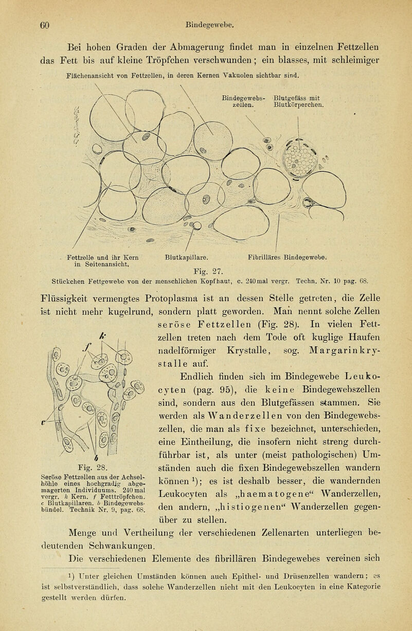 Bei hohen Graden der Abmagerung findet man in einzehien Fettzellen das Fett bis auf kleine Tröpfchen verschwunden; ein blasses, mit schleimiger Fläclienansicht von Fettzellen, in deren Kernen Vakuolen sichtbar sind. Bindegewebs- zellen. Blutgefäss mit Blutkörperchen. ■ 'Fettzelle und ihr Kern Blutkapillare. Fibrilläres Bindegewebe, in Seitenansicht. Fig. 27. Stückchen Fettgewebe von der menschlichen Kopfhaut, c. 240mal vergr. Techn. Nr. 10 pag. 68. Flüssigkeit vermengtes Protoplasma ist an dessen Stelle getreten, die Zelle ist nicht mehr kugelrund, sondern platt geworden. Man nennt solche Zellen seröse Fettzellen (Fig. 28j. In vielen Fett- zellen treten nach dem Tode oft kuglige Haufen nadeiförmiger Krystalle, sog. Margarinkry- stalle auf. Endlich finden sich im Bindegewebe Leuko- cyten (pag. 95), die keine Bindegewebszellen sind, sondern aus den Blutgefässen stammen. Sie werden als Wanderzellen von den Bindegewebs- zellen, die man als fixe bezeichnet, unterschieden, eine Eintheilung, die insofern nicht streng durch- führbar ist, als unter (meist pathologischen) Um- ständen auch die fixen Bindegewebszellen wandern können^); es ist deshalb besser, die wandernden Leukocyten als „haematogene Wanderzellen, den andern, ,,histiogenen Wanderzellen gegen- über zu stellen. Menge und Vertheilung der verschiedenen Zellenarten unterliegen be- deutenden Schwankungen. Die verschiedenen Elemente des fibrillären Bindegewebes vereinen sich 1) Unter gleichen Umständen können auch Epithel- und Drüsenzellen wandern; es ist selbstverständlich, dass solche Wanderzellen nicht mit den Leukocyten in eine Kategorie gestellt werden dürfen. Fig. 28. Seröse Fettzellen aus der Achsel- höhle eines hochgradig abge- magerten Individuums. 240 mal vergr. k Kern, f Fetttröpfchen. c Blutkapillaren, b Bindegewebs- biindel. Technik Nr. 9, pag. 68.