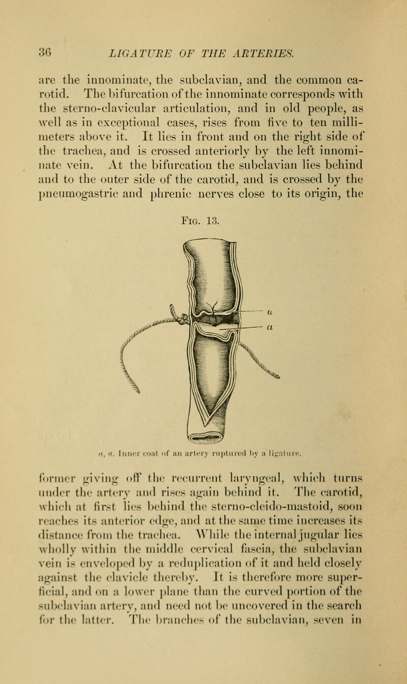 are the innominate, the subclavian, and the common ca- rotid. The bifurcation of the innominate corresponds with the sterno-clavicular articulation, and in old people, as well as in exceptional cases, rises from five to ten milli- meters above it. It lies in front and on the right side of the trachea, and is crossed anteriorly by the left innomi- nate vein. At the bifurcation the subclavian lies behind and to the outer side of the carotid, and is crossed by the pneumogastrie and phrenic nerves close to its origin, the Fig. 13. </, «. Inner coal of an artery ruptured by a ligature, former giving off the recurrent laryngeal, which turns under the artery and rises again behind it. The carotid, which at first lies behind the sterno-cleido-mastoid, soon reaches it- anterior edge, and at the same time increases its distance from the trachea. While the internal jugular lies wholly within the middle cervical fascia, the subclavian vein i- enveloped by a reduplication of it and held closely againsl the clavicle thereby. It is therefore more super- ficial, and on ;i lower plane than the curved portion of the subclavian artery, and need not be uncovered in the seai-(d) for the latter. The branches of the subclavian, seven in