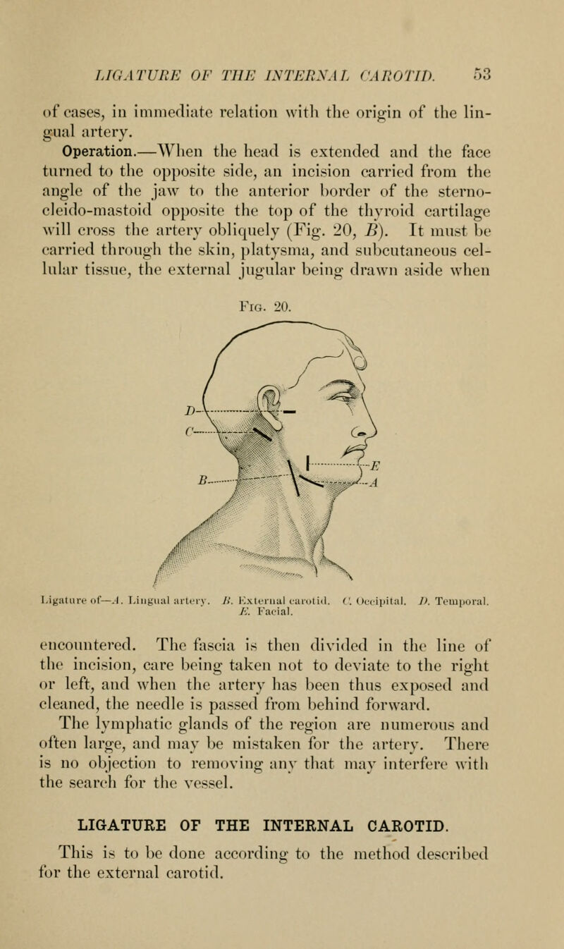 of cases, in immediate relation with the origin of the lin- gual artery. Operation.—When the head is extended and the face turned to the opposite side, an incision carried from the angle of the jaw to the anterior border of the sterno- cleido-mastoid opposite the top of the thyroid cartilage will cross the artery obliquely (Fig. 20, B). It must be carried through the skin, platysma, and subcutaneous cel- lular tissue, the external jugular being drawn aside when Fig. 20. Ligature of—A. Lingual art< />'. External carotid. C Occipital. 1>. Temporal. A'. Facial. encountered. The fascia is then divided in the line of the incision, care being taken not to deviate to the right or left, and when the artery has been thus exposed and cleaned, the needle is passed from behind forward. The lymphatic glands of the region are numerous and often large, and may be mistaken for the artery. There is no objection to removing any that may interfere with the search for the vessel. LIGATURE OF THE INTERNAL CAROTID. This is to be done according to the method described for the external carotid.