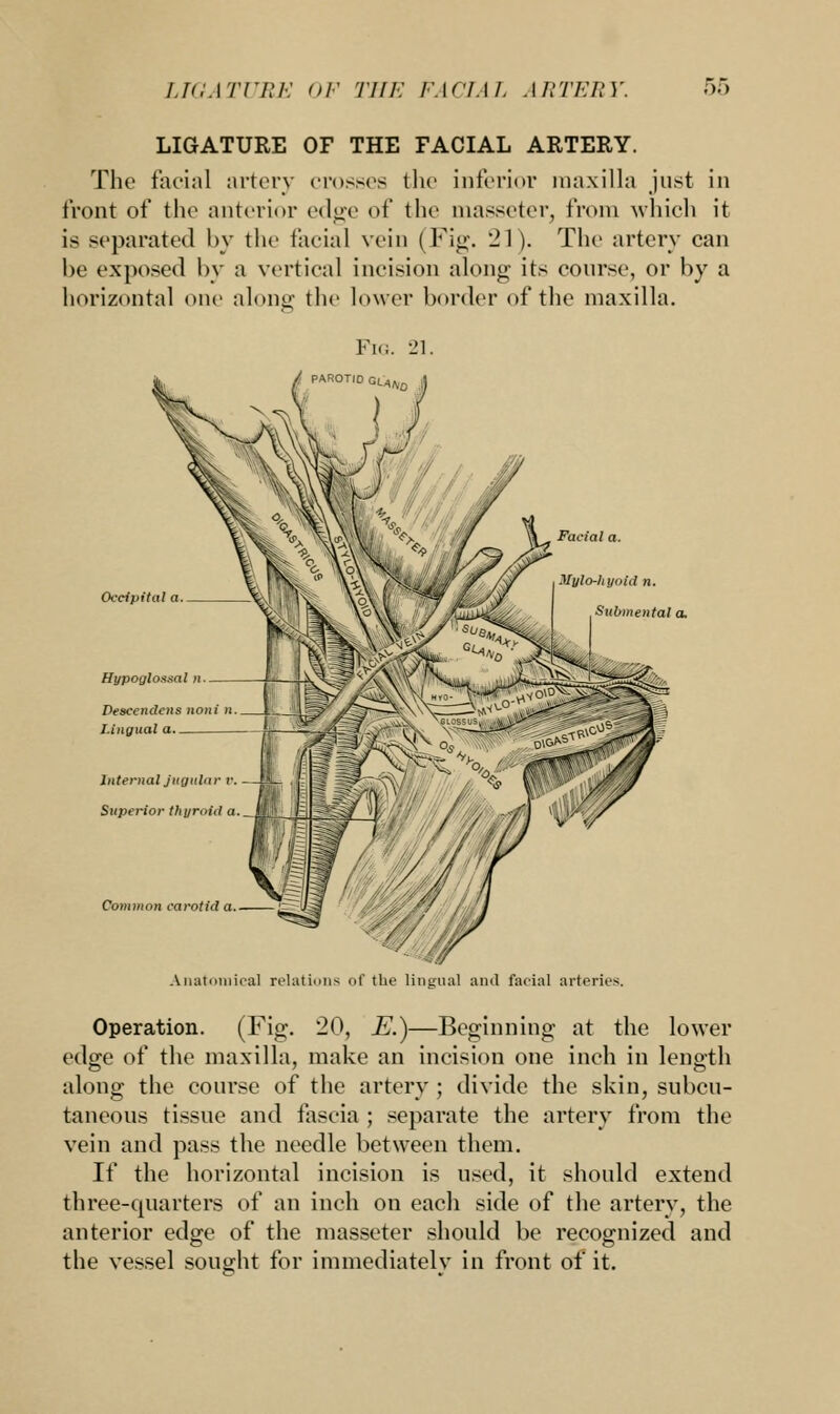 LIGATURE OF THE FACIAL ARTERY. The facial artery crosses the inferior maxilla just in front of the anterior edge of the niasseter, from which it is separated by the facial vein (Fig. 21). The artery can he exposed by a vertical incision along its course, or by a horizontal one along the lower border of the maxilla. Fig. 21. PAROTID aiA,No Occipital a._ Facial a. Mylohyoid n. Submental a. Hypoglossal n Descendcns noni n Lingual a Internal jugular v. Superior thyroid a Common carotid Anatomies] relations of the lingual and facial arteries. Operation. (Fig. 20, E.)—Beginning at the lower edge of the maxilla, make an incision one inch in length along the course of the artery ; divide the skin, subcu- taneous tissue and fascia ; separate the artery from the vein and pass the needle between them. If the horizontal incision is used, it should extend three-quarters of an inch on each side of the artery, the anterior edge of the masseter should be recognized and the vessel sought for immediately in front of it.