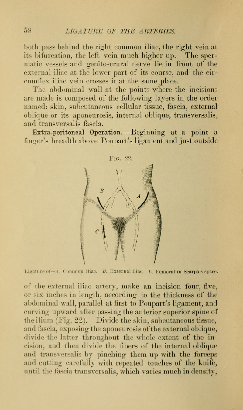 both pass behind the right common iliac, the right vein at its bifurcation, the left vein much higher up. The sper- matic vessels and genito-crural nerve lie in front of the external iliac at the lower part of its course, and the cir- cumflex iliac vein crosses it at the same place. The abdominal wall at the points where the incisions are made is composed of the following layers in the order named: skin, subcutaneous cellular tissue, fascia, external oblique or its aponeurosis, internal oblique, transversalis, and transversalis fascia. Extra-peritoneal Operation.—Beginning at a point a finger's breadth above Poupart's ligament and just outside Fig. 22. Ligature of A. Coi on Iliac. B. External iliac, C. Femoral in Scarpa's space. of the external iliac artery, make an incision four, five, or six inches in length, according to the thickness of the abdominal wall, parallel at first to Poupart's ligament, and curving upward after passing the anterior superior spine of the ilium ( Fig. 22). J divide the skin, subcutaneous tissue, and fascia, exposing the aponeurosis of the external oblique, divide the latter throughout the whole extent of the in- cision, and then divide the fibers of the internal oblique and transversalis by pinching them up with the forceps and cutting carefully with repeated touches of the knife, until the fascia transversalis, which varies much in density.