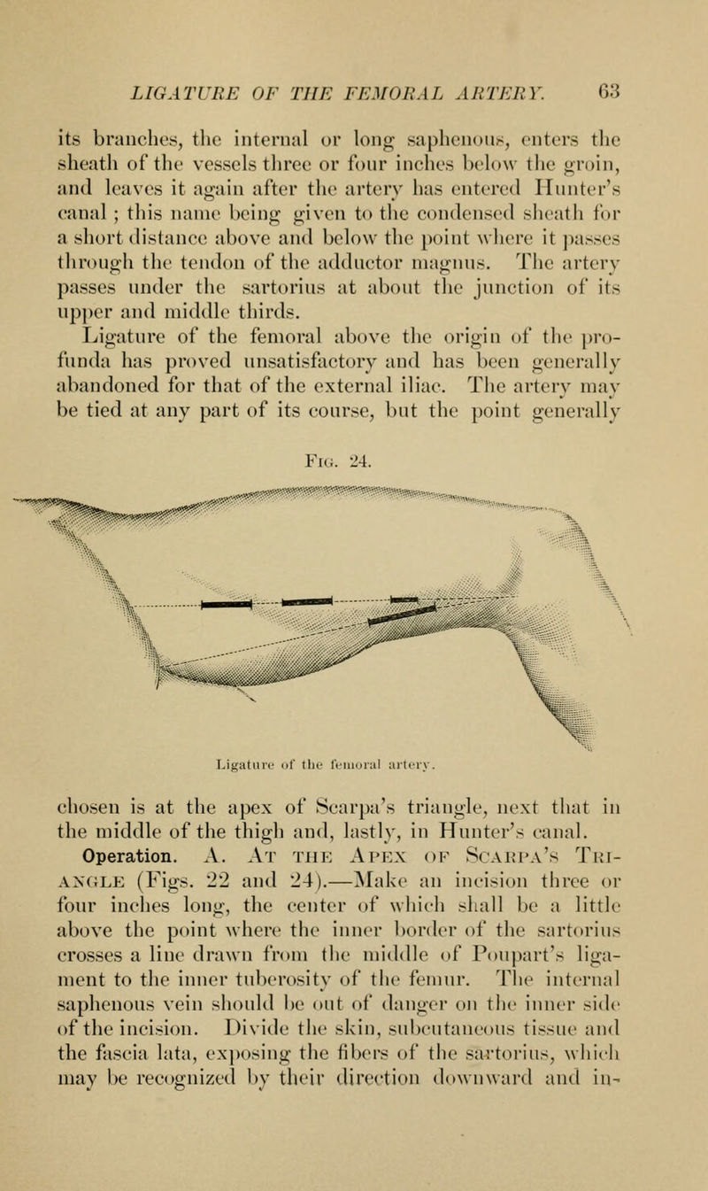 its branches, the internal or long saphenous, enters the sheath of the vessels three or four inches below the groin, and leaves it again after the artery has entered Hunter's canal ; this name being given to the condensed sheath for a short distance above and below the point where it passes through the tendon of the adductor inagnus. The artery passes under the sartorius at about the junction of its upper and middle thirds. Ligature of the femoral above the origin of the pro- funda has proved unsatisfactory and has been generally abandoned for that of the external iliac. The artery may be tied at any part of its course, but the point generally Fig. 24. Ligature of the femoral arterj . chosen is at the apex of Scarpa's triangle, next that in the middle of the thigh and, lastly, in Hunter's canal. Operation. A. At the Ai-kx of Scarpa's Tri- angle (Figs. 22 and 24).—Make an incision three or four inches long, the center of which shall be a little- above the point where the inner border of the sartorius crosses a line drawn from the middle of Poupart's liga- ment to the inner tuberosity of the femur. The internal saphenous vein should be out of danger on the inner side of the incision. Divide the skin, subcutaneous tissue and the fascia lata, exposing the fibers of the sartorius, which may be recognized by their direction downward and in-
