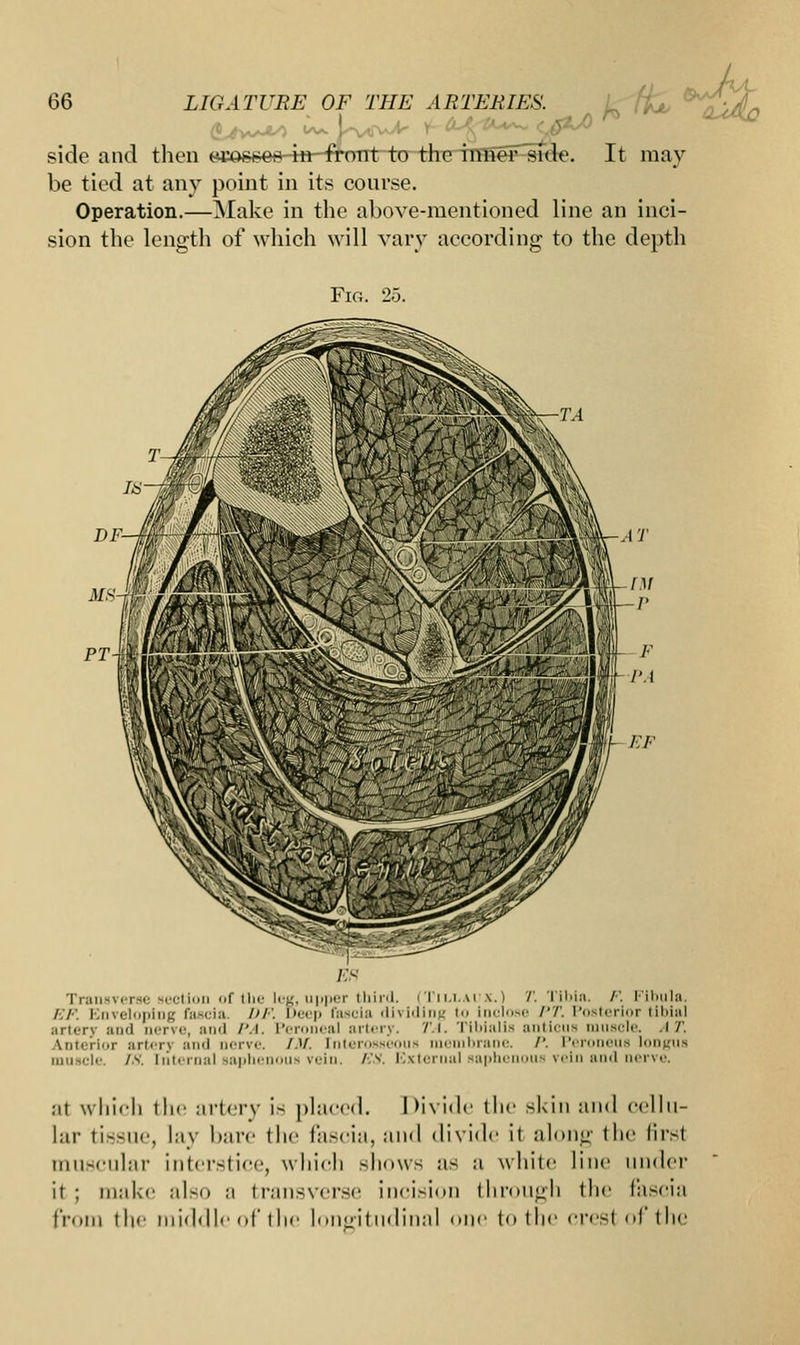 side and then w*>s*erv4tr-frorit to the mueFsfde. It may be tied at any point in its course. Operation.—Make in the above-mentioned line an inci- sion the length of which will vary according to the depth Fig. 25. Transverse section of the leg, upper third. (Tillaux.) T. Tibia. /•'. Fibula. /./■: Enveloping fascia DF. Deep fascia 'li\i'liirj to Inclose /'/'. Posterior tibial artery and nerve, and PA. Peroneal artery. TA. Tibialis anticus sole. AT. Interior arterj and nerve. /.'/. [nteross - membrane. P. Peroneus longus muscle. TS. internal saphenous vein. ES. External saphenous vein and nerve. ;it which the artery is placed. Divide the skin and cellu- lar tissue, lay bare the fascia, and divide it along (lie firsl muscular interstice, which shows as a while line under ii ; make also ;i transverse incision through the fascia from t he middle of the longitudinal one to the crest of the