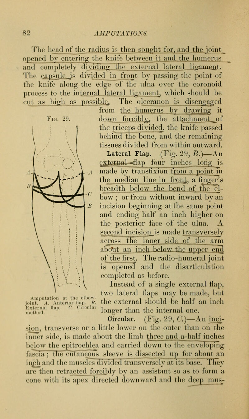 The head of the.radius is then sought foiyand the joint_ opened by entering the knife between it and the humerus and completely dividing the external lateral ligament. The <ap.-ulc.Js divided in front by passing the point of the knife along the edge of the ulna over the eoronoid process to the internal lateral ligament, which should be cut as high as possible,, The olecranon is disengaged from the humerus by drawing it Fig. 29. down forcibly, the attaehment_^pf the triceps divided, the knife passed behind the bone, and the remaining tissues divided from within outward. Lateral Flap. (Fig. 29, B.)—An e^ernnl -flap four inches long is a made by transfixion from a pointjn the median line in froirfc, a finger's breadth below the bend of the el- bow ; or from without inward by an incision beginning at the same point and ending half an inch higher on the posterior face of the ulna. A second incisionals made transversely across the inner side of the arm aboilt an inch below the upper cim] of the first. The radio-humeral joint is opened and the disarticulation completed as before. Instead of a single external flap, two lateral flaps may be made, but the external should be half an inch longer than the internal one. Circular. (Fig. 29, ('.)—An inci- sion, transverse or a little lower on the outer than on the inner side, is made about the limb three and a-half inches below the epitrochlea and carried down to the enveloping fascia; the cutaneous sleeve is dissected up for aboutan inch and the muscles divided transversely at its baseTTliey are then retracted forcibly by an assistant BO as to form a • •one with its apex directed downward and the deep inusj- Amputation al the elbow- joint. .1. Anterior Bap. B. External flap. C. Circular method,