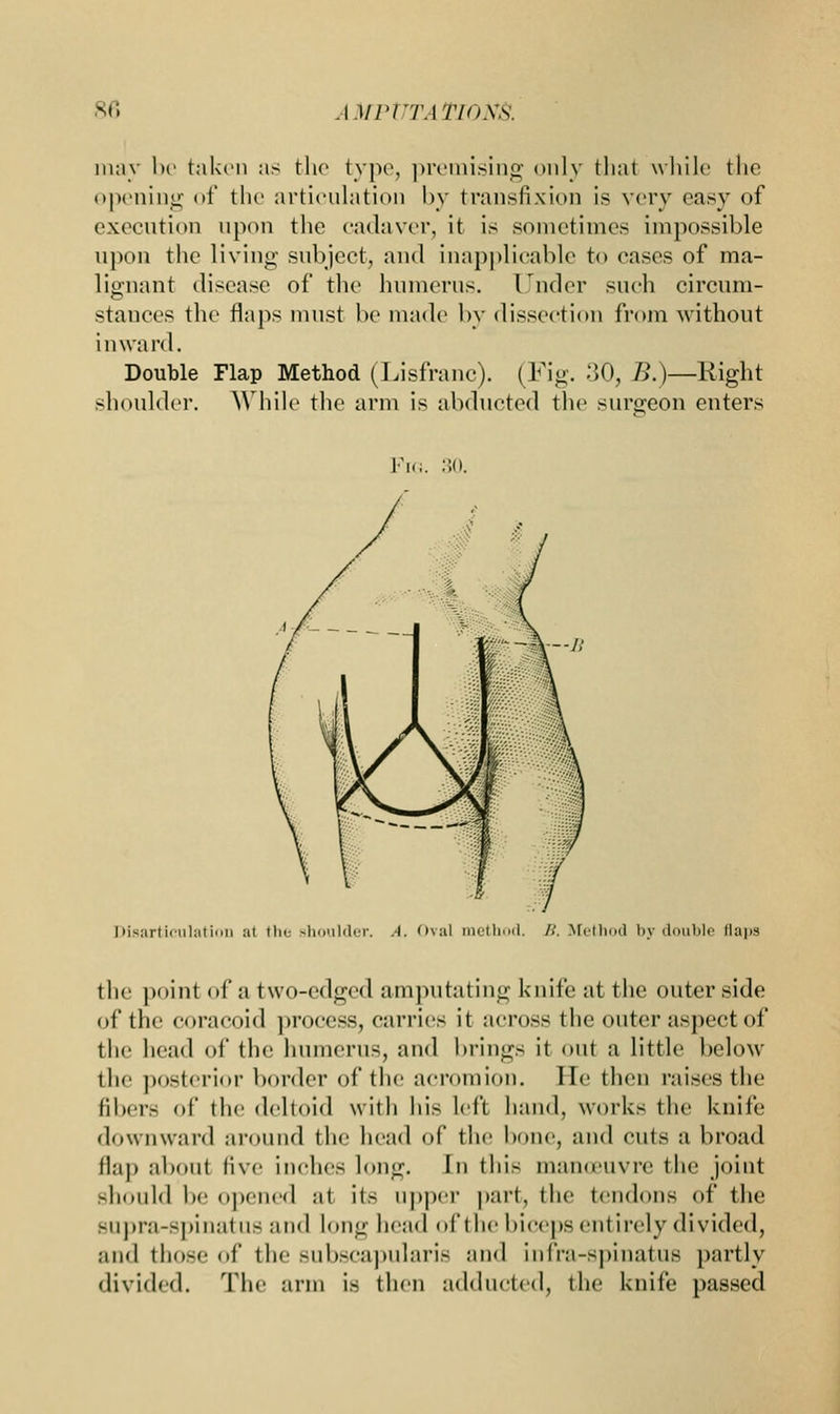 may be taken as the type, premising only thai while the opening of the articulation by transfixion is very easy of execution upon the cadaver, it is sometimes impossible upon the living subject, and inapplicable to eases of ma- lignant disease of the humerus. Under such eirenni- stances the flaps must be made by dissection from without inward. Double Flap Method (Lisfranc). (Fig. 30, B.)—Right shoulder. While the arm is abducted the surgeon enters Fk 30. Disarticulation al the shoulder. A. Oval method. /.'. Method by double Saps the point of a two-edged amputating knife at the outer side of the eoracoid process, carries it across the outer aspect of the head of the humerus, and brings it out a little below the posterior border of the acromion, lie then raises the fibers of the deltoid with his left hand, works the knife downward around the head of the bone, and cuts a broad flap about five inches long. In this manoeuvre the joint should be opened :it its upper part, the tendons of the siipra-spinatns and long head oft he biceps entirely divided, and those of the subscapularis and infra-spinatus partly divided. The arm is then adducted, the knife passed
