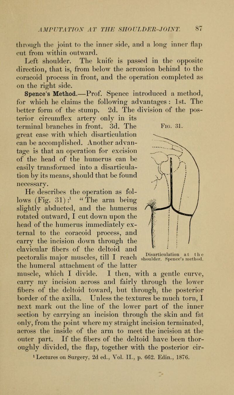 and a loiio- innei fla Fig. 31. through the joint to the inner side cut from within outward. Left shoulder. The knife is passed in the opposite direction, that is, from below the acromion behind to the eoracoid process in front, and the operation completed as on the right side. Spence's Method.—Prof. Spence introduced a method, for which he claims the following advantages : 1st. The better form of the stump. 2d. The division of the pos- terior circumflex artery only in its terminal branches in front. 3d. The great ease with which disarticulation can be accomplished. Another advan- tage is that an operation for excision of the head of the humerus can be easily transformed into a disarticula- tion by its means, should that be found necessary. He describes the operation as fol- lows (Fig. 31) :x  The arm being slightly abducted, and the humerus rotated outward, I cut down upon the head of the humerus immediately ex- ternal to the eoracoid process, and carry the incision down through the clavicular fibers of the deltoid and v • i ,.ii x l Disarticulation at the pectoralis major muscles, till 1 reach shoulder. Spence's method, the humeral attachment of the latter muscle, which I divide. I then, with a gentle curve, carry my incision across and fairly through the lower fibers of the deltoid toward, but through, the posterior border of the axilla. Unless the textures be much torn, I next mark out the line of the lower part of the inner section by carrying an incision through the skin and fat only, from the point where my straight incision terminated, across the inside of the arm to meet the incision at the outer part. If the fibers of the deltoid have been thor- oughly divided, the flap, together with the posterior cir- 1 Lectures on Surgery, 2d ed., Vol. II., p. 662. Edin., 1876.