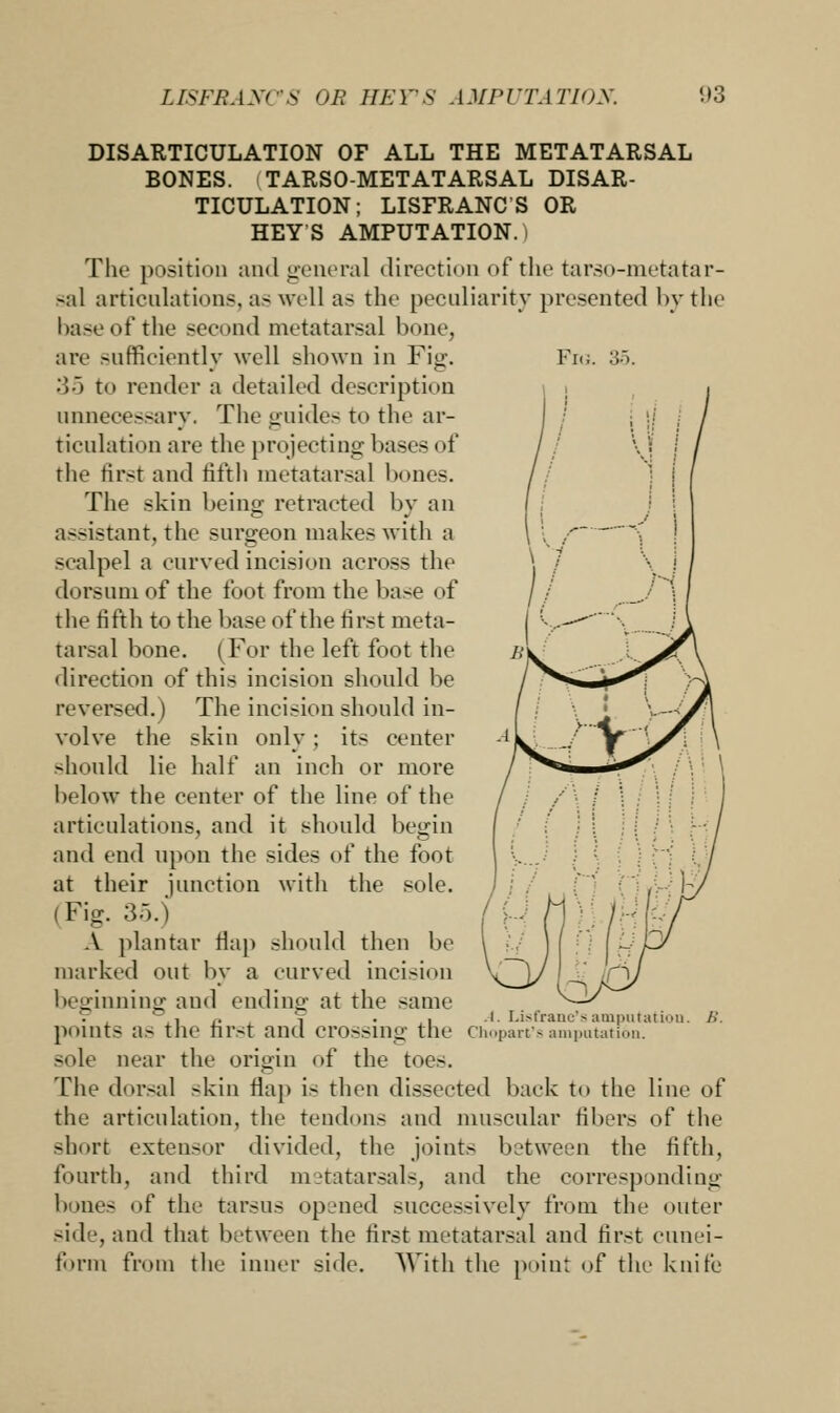Fig. 35. DISARTICULATION OF ALL THE METATARSAL BONES. TARSOMETATARSAL DISAR- TICULATION; LISFRANCS OR HEY'S AMPUTATION.) The position and general direction of the tarso-metatar- sal articulations, a- well as the peculiarity presented by the base of the second metatarsal bone, are sufficiently well shown in Fig. 35 to render a detailed description unnecessary. The guides to the ar- ticulation are the projecting liases of the first and fifth metatarsal bones. The skin being retracted by an assistant, the surgeon makes with a scalpel a curved incision across the dorsum of the foot from the base of the fifth to the base of the first meta- tarsal bone. (For the left foot the direction of this incision should be reversed.) The incision should in- volve the skin only; its center should lie half an inch or more below the center of the line of the articulations, and it should begin and end upon the sides of the foot at their junction with the sole. (Fig. 35.) A plantar flap should then be marked out by a curved incision be^inninu- and ending at the same ,, r, 5 ... .4. Lisfranc's amputation. A*, points a.- the first and CrOSSing the Chopart'samputation. sole near the origin of the toes. The dorsal -kin flap i- then dissected back to the line of the articulation, the tendons and muscular fibers of the short extensor divided, the joints between the fifth, fourth, and third metatarsals, and the corresponding bones of the tarsus opened successively from the outer side, and that between the first metatarsal and first cunei- form from the inner side. With the point of the knife