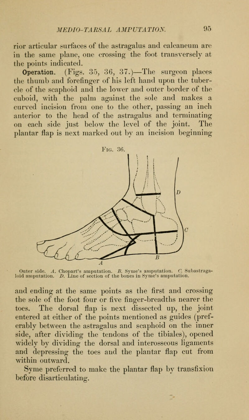 rior articular surfaces of the astragalus and calcaneum arc in the same plane, cue crossing the foot transversely at the points indicated. Operation. (Figs. 35, 36, 37.)—The surgeon places the thumb and forefinger of his left hand upon the tuber- cle of the scaphoid and the lower and outer border of the cuboid, with the palm against the sole and makes a curved incision from one to the other, passing an inch anterior to the head of the astragalus and terminating on each side just below the level of the joint. The plantar flap is next marked out by an incision beginning Fig. 36. Outer side. .1. Chopart's amputation. B. Syme's amputation. C. Subastraga- loid amputation. D. Line of section of the bones in Syme's amputation. and ending at the same points as the first and crossing the sole of the foot four or five finger-breadths nearer the toes. The dorsal flap is next dissected up, the joint entered at either of the points mentioned as guides (pref- erably between the astragalus and scaphoid on the inner side, after dividing the tendons of the tibiales), opened widely by dividing the dorsal and interosseous ligaments and depressing the toes and the plantar flap cut from within outward. Syme preferred to make the plantar flap by transfixion before disarticulating.