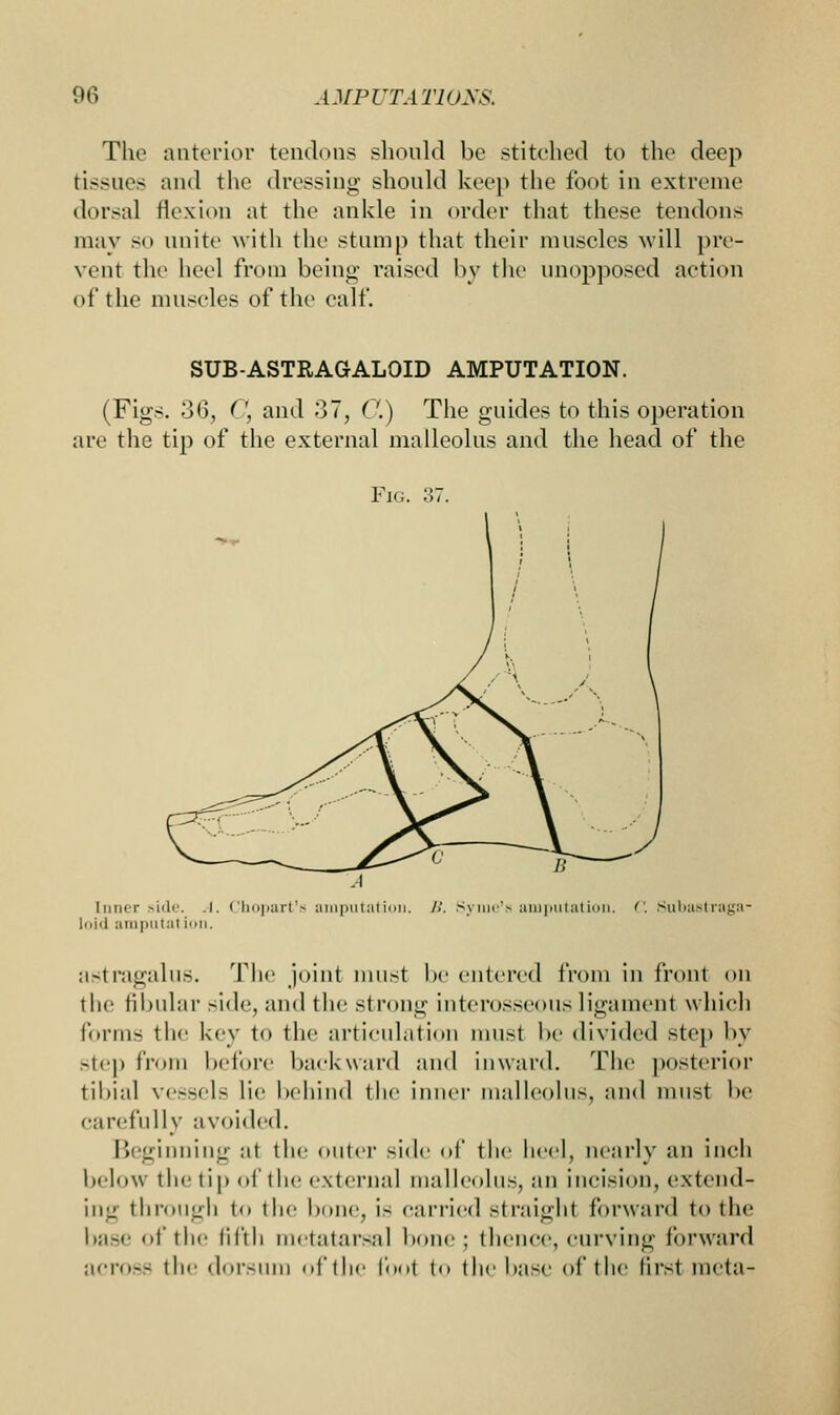 The anterior tendons should be stitched to the deep tissues and the dressing should keep the foot in extreme dorsal flexion at the ankle in order that these tendons may SO unite with the stump that their muscles will pre- vent the heel from being raised by the unopposed action of the muscles of the calf. SUB-ASTRAGALOID AMPUTATION. (Figs. 36, (', and 37, C.) The guides to this operation are the tip of the external malleolus and the head of the Fig I inn i- side. .1.' Ihopart's loid amputal ion. imputal ioi ;ilil|iill;itiip|i. Subasl raga- astragalus. The joint must be entered from in front on the fibular side, and the strong interosseous ligament which forms th<' key to the articulation must be divided step by step from before backward and inward. The posterior tibial vessels lie behind the inner malleolus, and must be carefully avoided. Beginning at the outer side of the heel, nearly an inch below the tip of the external malleolus, an incision, extend- ing through to the bone, is carried straight forward to the base of the fifth metatarsal bom': thence, curving forward across the dorsum of the foot to die base of the first meta-