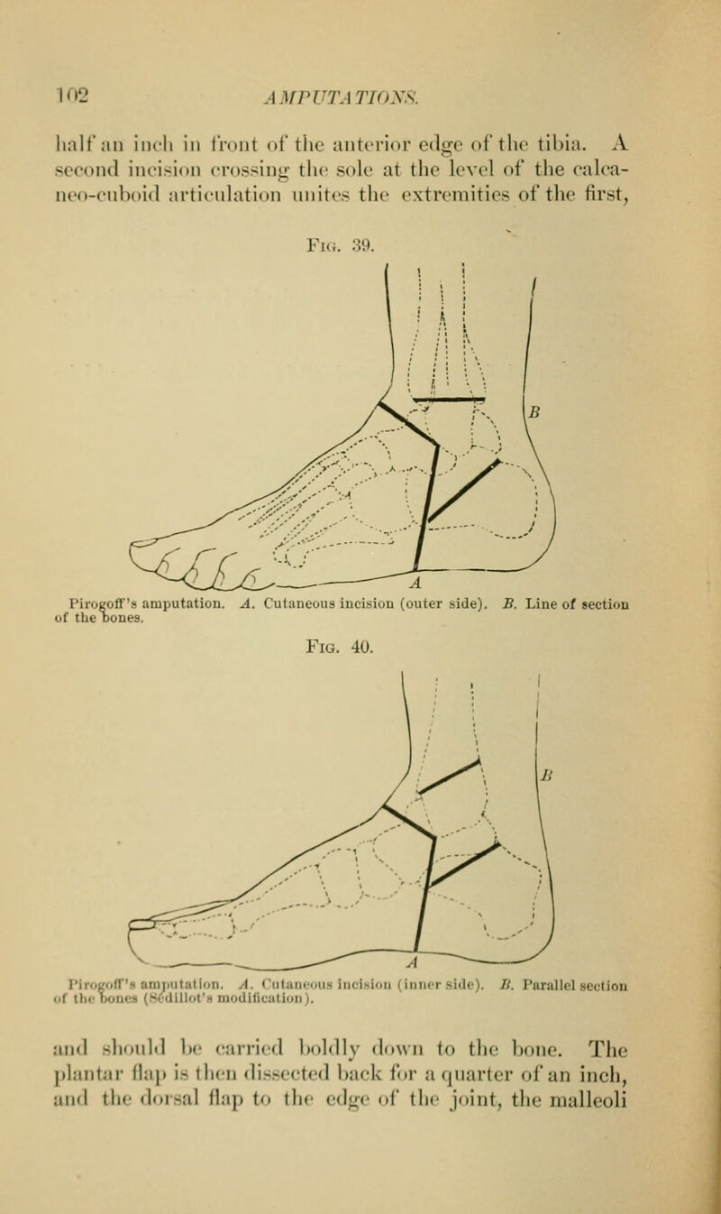 half an inch in front of the anterior edge of the tibia. A second incision crossing the sole at the level of the calca- ueo-cuboid articulation unites the extremities of the first, Fig. 39. Piroeoff's amputation. A. Cutaneous incision (outer side). B. Line of section of the Dones. Fig. 40. >ff'b amputation. A. Cutaneous Incision (inner Bide), B. Parallel section ..i the bones [Bt dillot's modification I. and should be carried boldly down to the bone. The plantar Bap ia then dissected l»;iel< for a quarter of an inch, and the dorsal flap to the edge of the joint, the malleoli