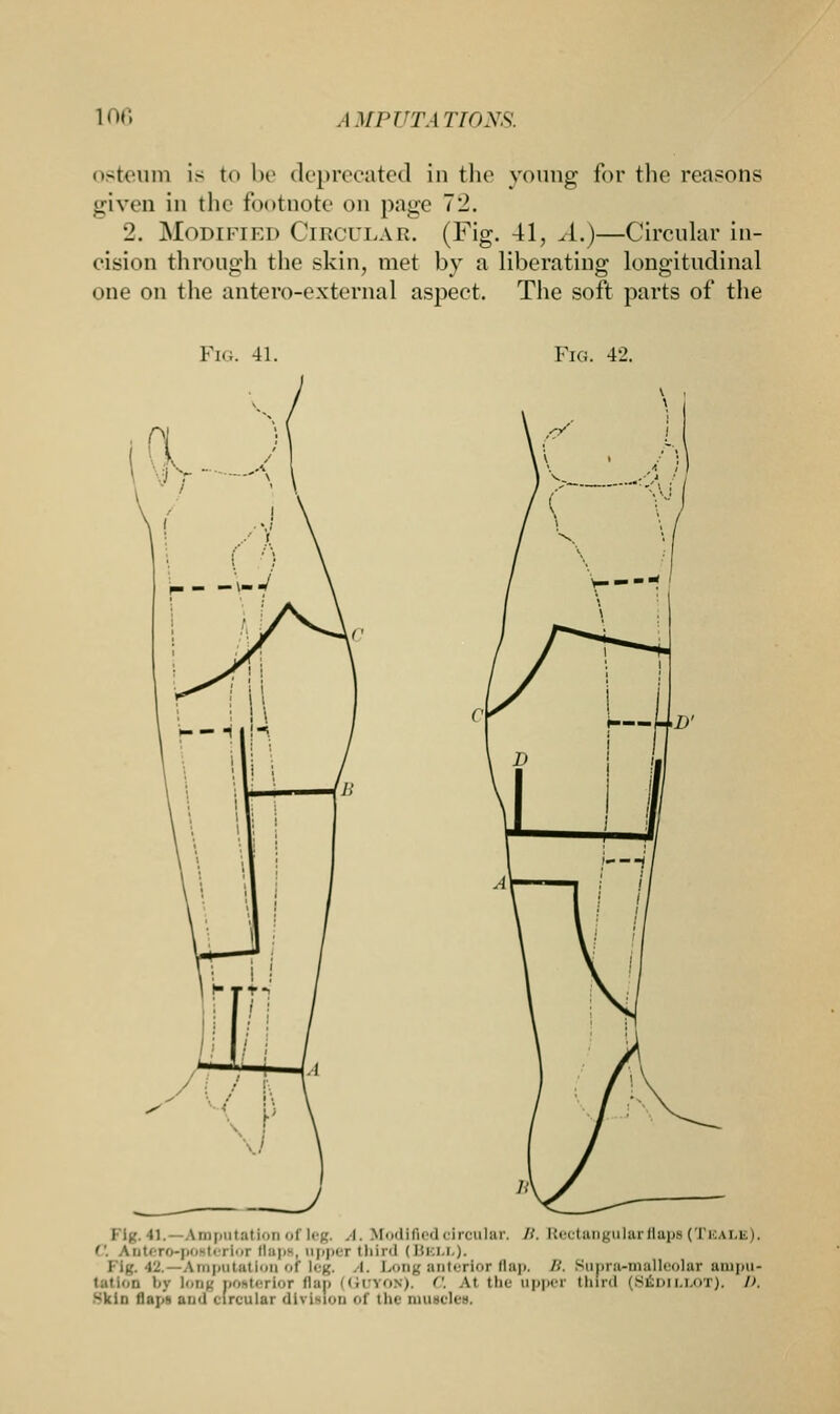 osteum is to be deprecated in the young for the reasons given in the toot note on page 72. 2. Modified Circular. (Fig. 41, A.)—Circular in- cision through the skin, met by a liberating longitudinal one on the antero-external aspect. The soft parts of the Fig. 41. Fig. 42. 11 Imputation of leg. A. Modified circular. /;. Rectangular flaps (Teale). ■■ ro-posterior flaps, upper third ( Ui.i.i ). -Amputation of leg. i. Long anterior flap. B. Bupra-malleolar ampu- tation i>y long posterior flan (Guyoh). 0. A.1 the upper third [St ox), D skin flap's and circular division <>f the muscles,