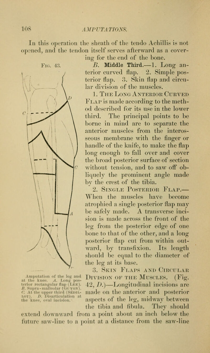 In thi- operation the sheath of the tendo Achillis is not opened, and the tendon itself serves afterward as a cover- ing for the end of the bone. Fig. 43. B. Middle Third.—1. Long an- terior curved flap. 2. Simple pos- terior flap. 3. Skin flap and circu- lar division of the muscles. 1. The Long Anterior Curved Flap is made according to the meth- od described for its use in the lower third. The principal points to be borne in mind are to separate the anterior muscles from the interos- seous membrane with the finger or handle of the knife, to make the flap long enough to fall over and cover the broad posterior surface of section without tension, and to saw off ob- liquely the prominent angle made by the crest of the tibia. 2. SlNGLE POSTERIOE FLAP. When the muscles have become atrophied a single posterior Hap may lie safely made. A transverse inci- sion is made across the front of the leg from the posterior edge of one bone to that of the other, and a long posterior flap cut from within out- ward, by transfixion. Its length should l)i' equal to the diameter of the leg at its base. :}. Skin Flaps and ( Jirculae Amputation of the leg and Division OF THE MUSCLES. (Fig. at tbe knee. A. Long \»<^- . , ... ectanaular flap (Lee). p> /).)—Longitudinal incisions are /.• -.i|.i i - m;ill. •■; ° . C At the upper third (Sedil- made on t lie anterior and posterior ii illation :it ,. , i i •! i (he knei oval Incision, aspects ol the leg, midway hetween the tibia and fibula. They should extend downward from a point about an inch below the future Baw-line to a point at a distance from the saw-line