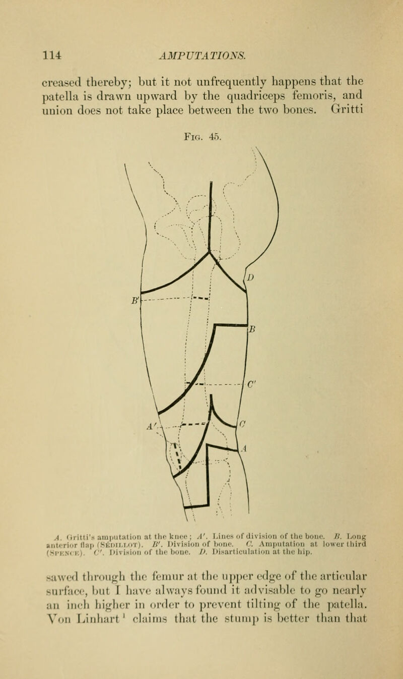 creased thereby; but it not unfrequently happens that the patella is drawn upward by the quadriceps femoris, and union docs not take place between the two bones. Gritti Fig. 4o. i Qritti's amputation at the knee; A'. Lines of division of the bone. //. Long anterior flap (8£dillot). W. Division of bone. C. Amputation al lower third Division of the bone. D. Disarticulation at the hip. sawed through the femur al the upper edge of the articular surface, but I have alwaysfound it advisable to go nearly an inch higher in order to prevent tilting of the patella. Von Linharl ' claims that the stump is better than that