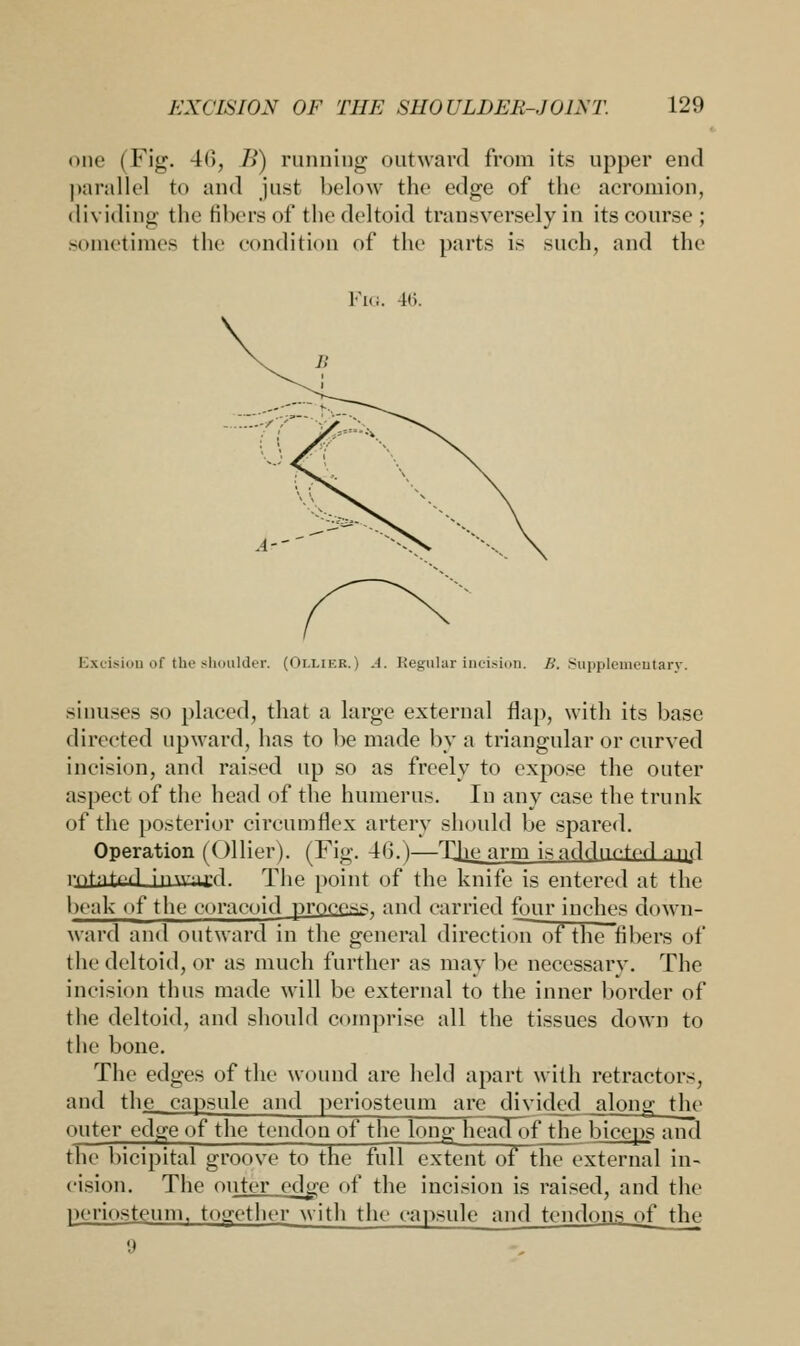 one (Fig. 4(), B) running outward from its upper end parallel to and just below the edge of the acromion, dividing the fibers of the deltoid transversely in its course; sometimes the condition of the parts is such, and the Fig. 16. Excision of the shoulder. (Olliek.) A. Regular incision. B. Supplementary. sinuses so placed, that a large external flap, with its base directed upward, has to be made by a triangular or curved incision, and raised up so as freely to expose the outer aspect of the head of the humerus. In any case the trunk of the posterior circumflex artery should be spared. Operation (Oilier). (Fig. 46.)—The arm isnddncted nnd riihiiuiJiuua'd. The point of the knife is entered at the beak of the eoracoid process, and carried four inches down- ward and outward in the general direction of the Abel's of the deltoid, or as much further as may be necessary. The incision thus made will be external to the inner border of the deltoid, and should comprise all the tissues down to the bone. The edges of the wound are held apart with retractors, and the capsule and periosteum are divided along the outer edge of the tendon of the long; head of the biceps and the bicipital groove to the full extent of the external in- cision. The outer edge of the incision is raised, and the periosteum, together with the capsule and tendons of _the 9