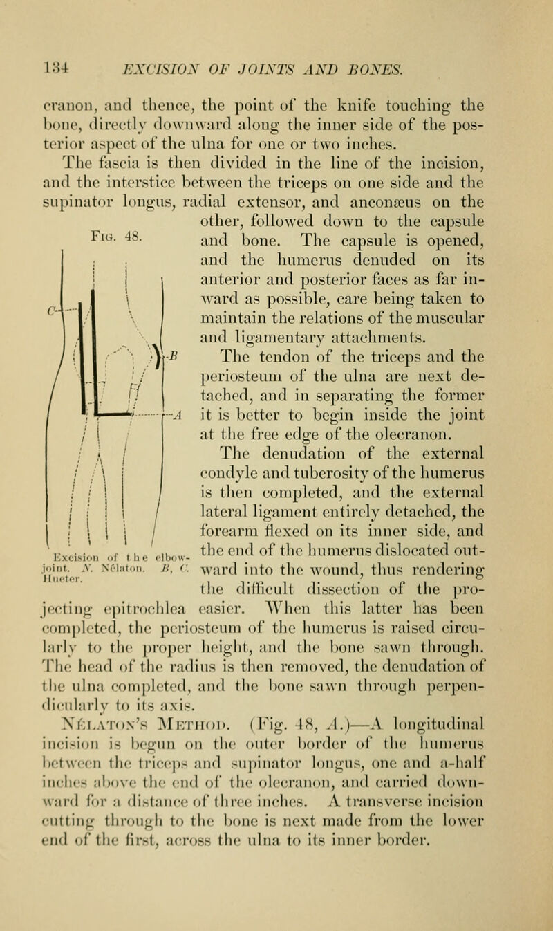 Fig. 48. H -t-A A cranon, and thence, the point of the knife touching the bone, directly downward along the inner side of the pos- terior aspect of the ulna for one or two inches. The fascia is then divided in the line of the incision, and the interstice between the triceps on one side and the supinator longus; radial extensor, and anconeus on the other, followed down to the capsule and bone. The capsule is opened, and the humerus denuded on its anterior and posterior faces as far in- ward as possible, care being taken to maintain the relations of the muscular and ligamentary attachments. The tendon of the triceps and the periosteum of the ulna are next de- tached, and in separating the former it is better to begin inside the joint at the free edge of the olecranon. The denudation of the external condyle and tuberosity of the humerus is then completed, and the external lateral ligament entirely detached, the forearm flexed on its inner side, and the end of the humerus dislocated out- ward into the wound, thus rendering the difficult dissection of the pro- easier. When this latter has been completed, the periosteum of the humerus is raised circu- larly to the proper height, and the bone sawn through. The head of the radius is then removed, the denudation of the ulna completed, and the bone sawn through perpen- dicularly to its axis. \ i.i. vm\- Method. (Fig. 48, A.)—A longitudinal incision is begun on the outer border of the humerus between the triceps and supinator longus, one and a-half inches above the end of the olecranon, and carried down- ward for a distance of three inches. A transverse incision cutting through to tin' bone is next made from the lower end of the first, across the ulna to its inner border. Excision of t h <■ elbofl joint, .v. Nelaton. B, < Hueter. jecting epitrochlea