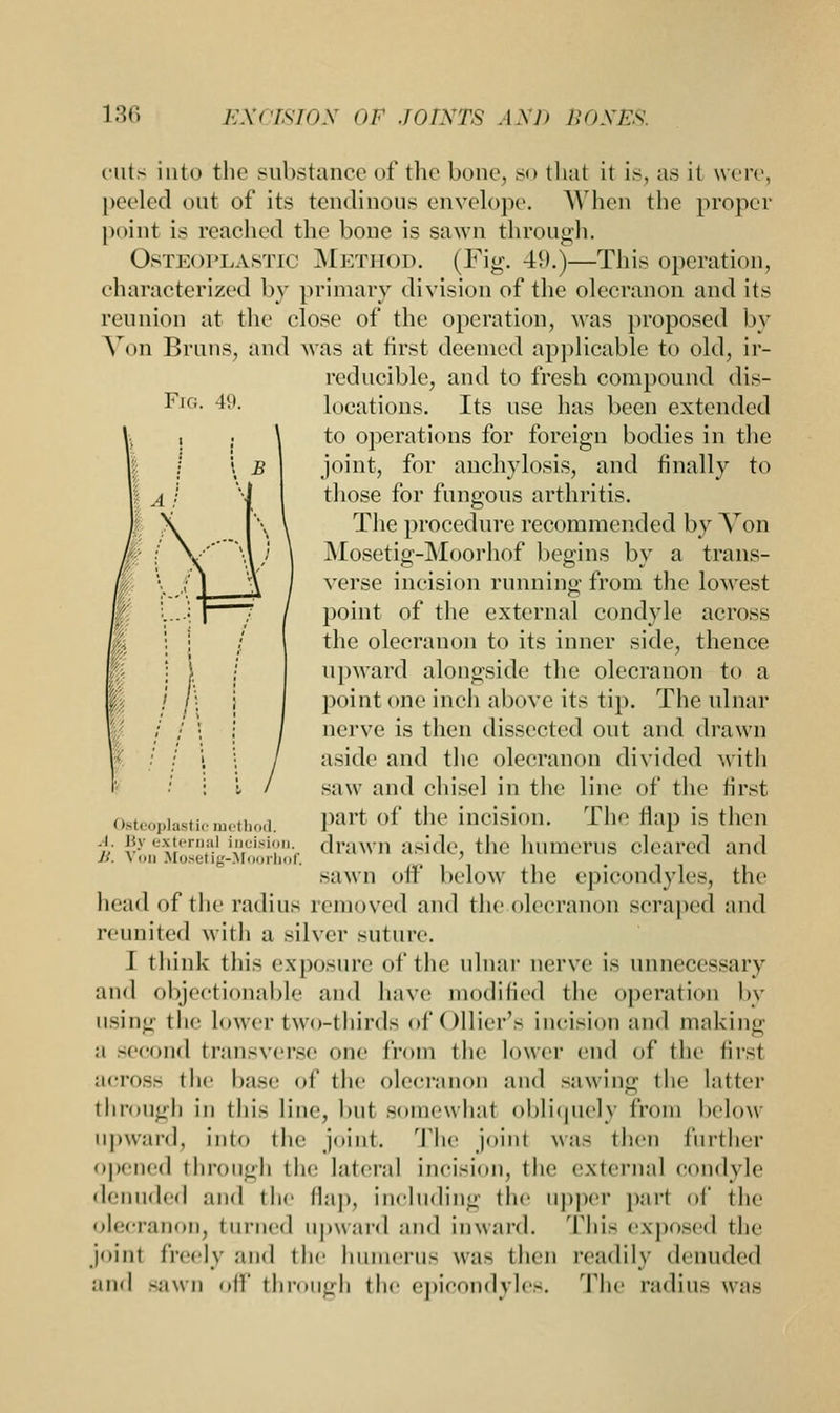 Fig cuts into the substance of the bone, so that it is, as it were peeled out of its tendinous envelope. When the proper point is reached the bone is sawn through. Osteoplastic Method. (Fig. 49.)—This operation, characterized by primary division of the olecranon and its reunion at the close of the operation, was proposed by Von Bruns, and was at first deemed applicable to old, ir- reducible, and to fresh compound dis- locations. Its use has been extended to operations for foreign bodies in the joint, for anchylosis, and finally to those for fungous arthritis. The procedure recommended by Von Mosetig-Moorhof begins by a trans- verse incision running from the lowest point of the external condyle across the olecranon to its inner side, thence upward alongside the olecranon to a point one inch above its tip. The ulnar nerve is then dissected out and drawn aside and the olecranon divided with saw and chisel in the line of the first part of the incision. The flap is then drawn aside, the humerus cleared and sawn oil' below the epicondyles, the head of the radius removed and the olecranon scraped and reunited with a silver suture. I think this exposure of the ulnar nerve is unnecessary and objectionable and have modified the operation by using the lower two-thirds ol'Ollier's incision and making a second transverse one from the lower end of the first across the base of the olecranon and sawing the latter through in this line, but somewhal obliquely from below upward, into the .joint. The join! was then further opened through the lateral incision, the external condyle denuded and the flap, including the upper part of the olecianon, turned upward and inward. This exposed the joint freely and the humerus wa- then readily denuded ami -awn oil' through the epicondvie-, 'flic radius was Osteoplastic method. .1. By externa] incision. ];. Von Mosetig-Moorhof.