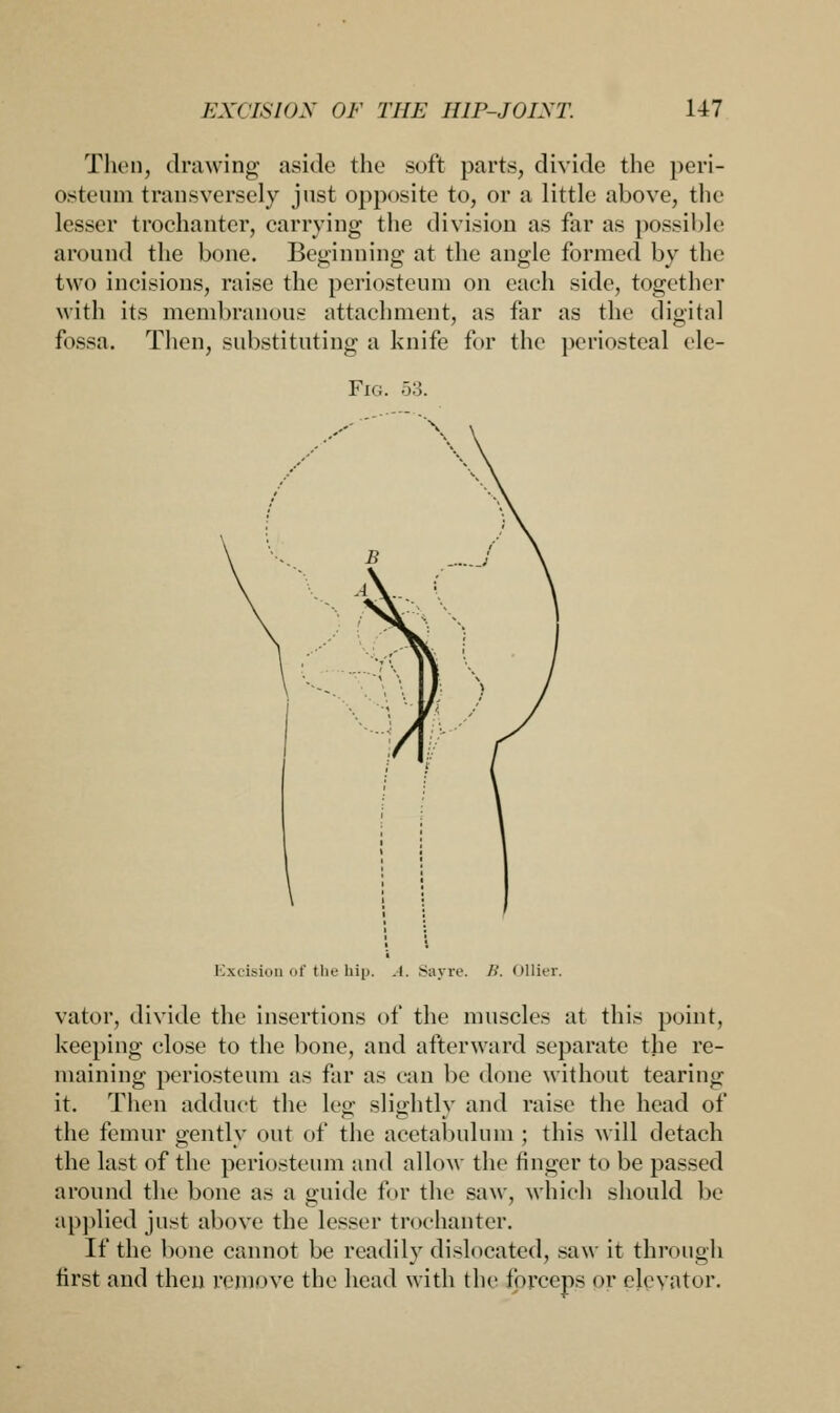 Then, drawing aside the soft parts, divide the peri- osteum transversely just opposite to, or a little above, the lesser trochanter, carrying the division as far as possible around the bone. Beginning at the angle formed bv the two incisions, raise the periosteum on each side, together with its membranous attachment, as far as the digital fossa. Then, substituting a knife for the periosteal ele- Fig. 53. Excision of the hip. A. Sayre. />'. Oilier. vator, divide the insertions of the muscles at this point, keeping close to the bone, and afterward separate the re- maining periosteum as far as can be done without tearing- it. Then adduct the leg slightly and raise the head of the femur gently out of the acetabulum ; this will detach the last of the periosteum and allow the finger to be passed around the bone as a guide for the saw, which should be applied just above the lesser trochanter. If the bone cannot be readily dislocated, saw it through first and then remove the head with the forceps or elevator.