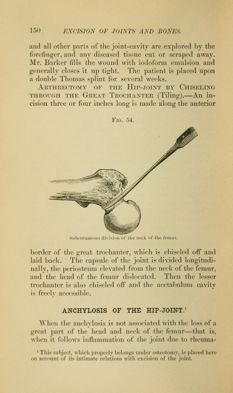 and all other parts of the joint-cavity are explored by the forefinger, and any diseased tissue cut or scraped away. Mr. Barker fills the wound with iodoform emulsion and generally closes it up tight. The patient is placed upon a double Thomas splint for several weeks. Abthbectomy of the Hip-joint by Chiseling through the Great Trociiaxter (Tiling).—An in- cision three or four inches long is made along the anterior Fig. 54. Subcutaneous dn ision of iliu neck <>f tin1 femur. border of the great trochanter, which is chiseled off and laid hack. The capsule of the joint is divided longitudi- nally, the periosteum elevated from the neck of the femur, and the head of the femur dislocated. Then the lesser trochanter is also chiseled off and the acetabulum cavity i- freely accessible. ANCHYLOSIS OF THE HIP-JOINT.1 When the anchylosis is no1 associated with the loss of a greal pari of the head and neck of the femur—that is, when it followe inflammation of the join! due to rheuma- 1 Tlii- Bubject, which properly belongs under osteotomy, Lb placed here ■ in account of its intimate relations with excision of the joint