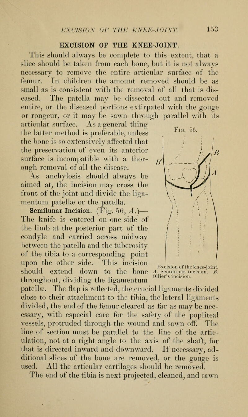 EXCISION OF THE KNEE-JOINT. This should always be complete to this extent, that a slice should be taken from each bone, but it is not always accessary to remove the entire articular surface of the femur. In children the amount removed should be as small as is consistent with the removal of all that is dis- eased. The patella may be dissected out and removed entire, or the diseased portions extirpated with the gouge or rongeur, or it may be sawn through parallel with its articular surface. As a general thing the latter method is preferable, unless the bone is so extensively affected that the preservation of even its anterior surface is incompatible with a thor- ough removal of all the disease. As anchylosis should always be aimed at, the incision may cross the front of the joint and divide the liga- mentum patella? or the patella. Semilunar Incision. (Fig. 56, .1.)— The knife is entered on one side of the limb at the posterior part of the condyle and carried across midway between the patella and the tuberosity of the tibia to a corresponding point upon the other side. This incision should extend down to the bone throughout, dividing the ligamentum patellae. The flap is reflected, the crucial ligaments divided close to their attachment to the tibia, the lateral ligaments divided, the end of the femur cleared as far as may be nec- essary, with especial care for the safety of the popliteal vessels, protruded through the wound and sawn off. The line of section must be parallel to the line of the artic- ulation, not at a right angle to the axis of the shaft, for that is directed inward and downward. If necessary, ad- ditional slices of the bone are removed, or the gouge is used. All the articular cartilages should be removed. The end of the tibia is next projected, cleaned, and sawn Excision of the knee-joint. .1. Semilunar incision. B. < >llier's incision.